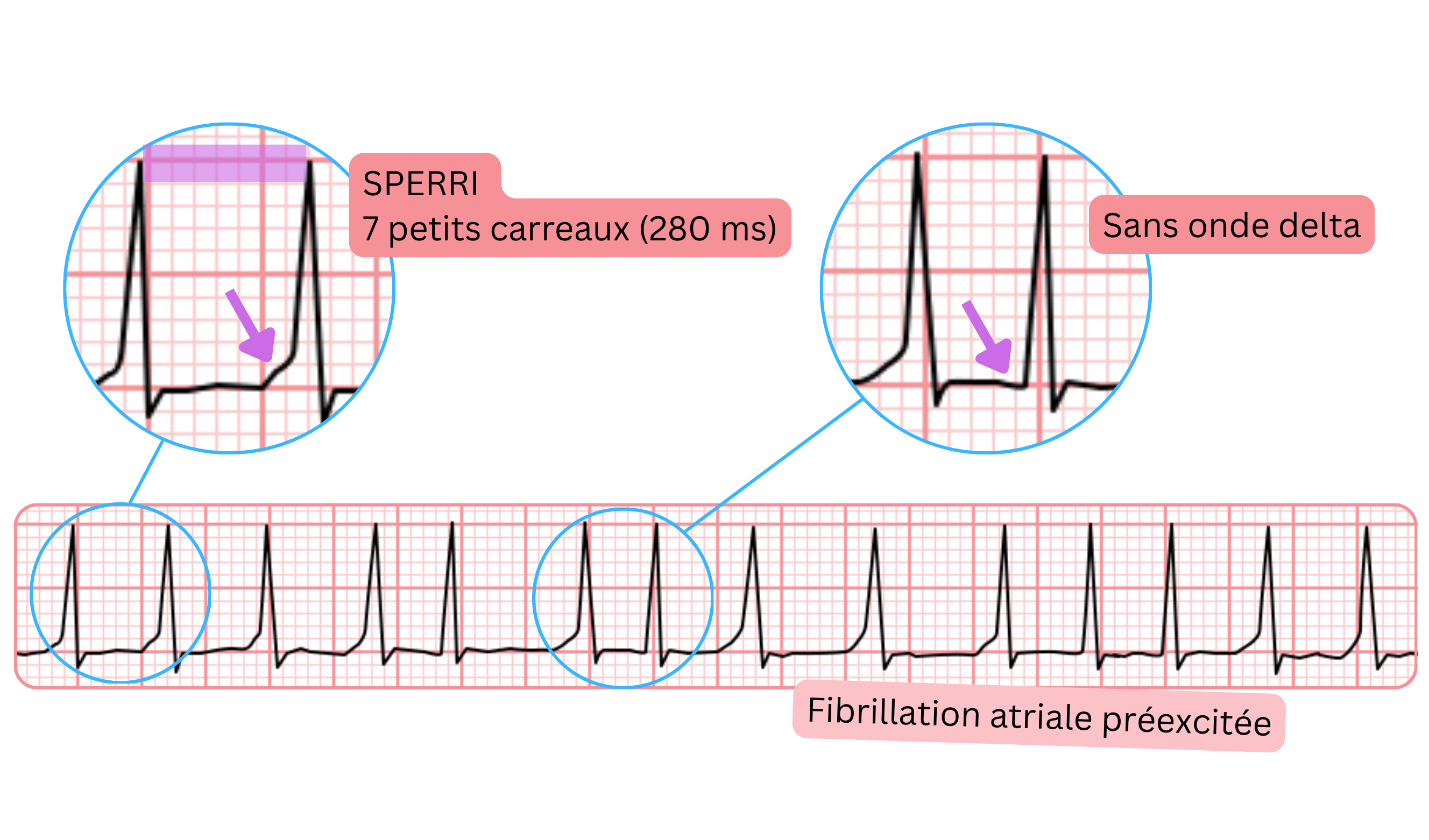 Fibrillation atriale préexcitée avec un SPERRI plus long de 280 ms et absence d’onde delta à l’ECG.