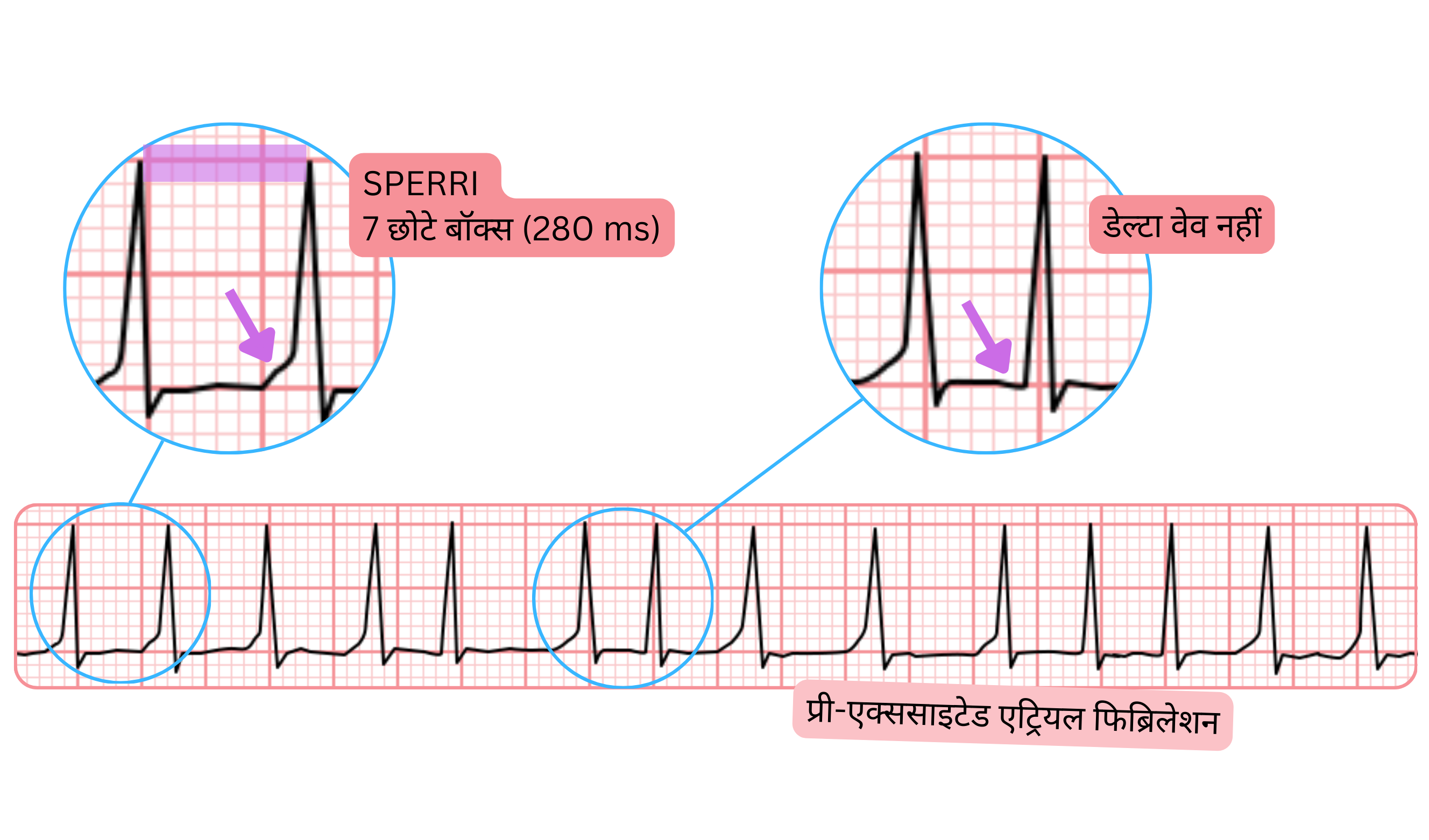 ईसीजी पर 280 मिलीसेकंड के लंबे SPERRI और डेल्टा वेव के अभाव के साथ प्रीएक्साइटेड एट्रियल फिब्रिलेशन।