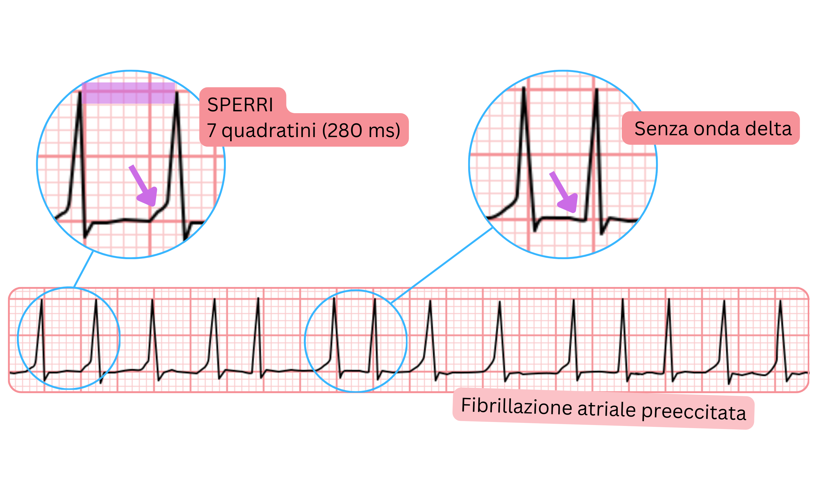 Fibrillazione atriale preeccitata con SPERRI più lungo di 280 ms e assenza di onda delta all’ECG.