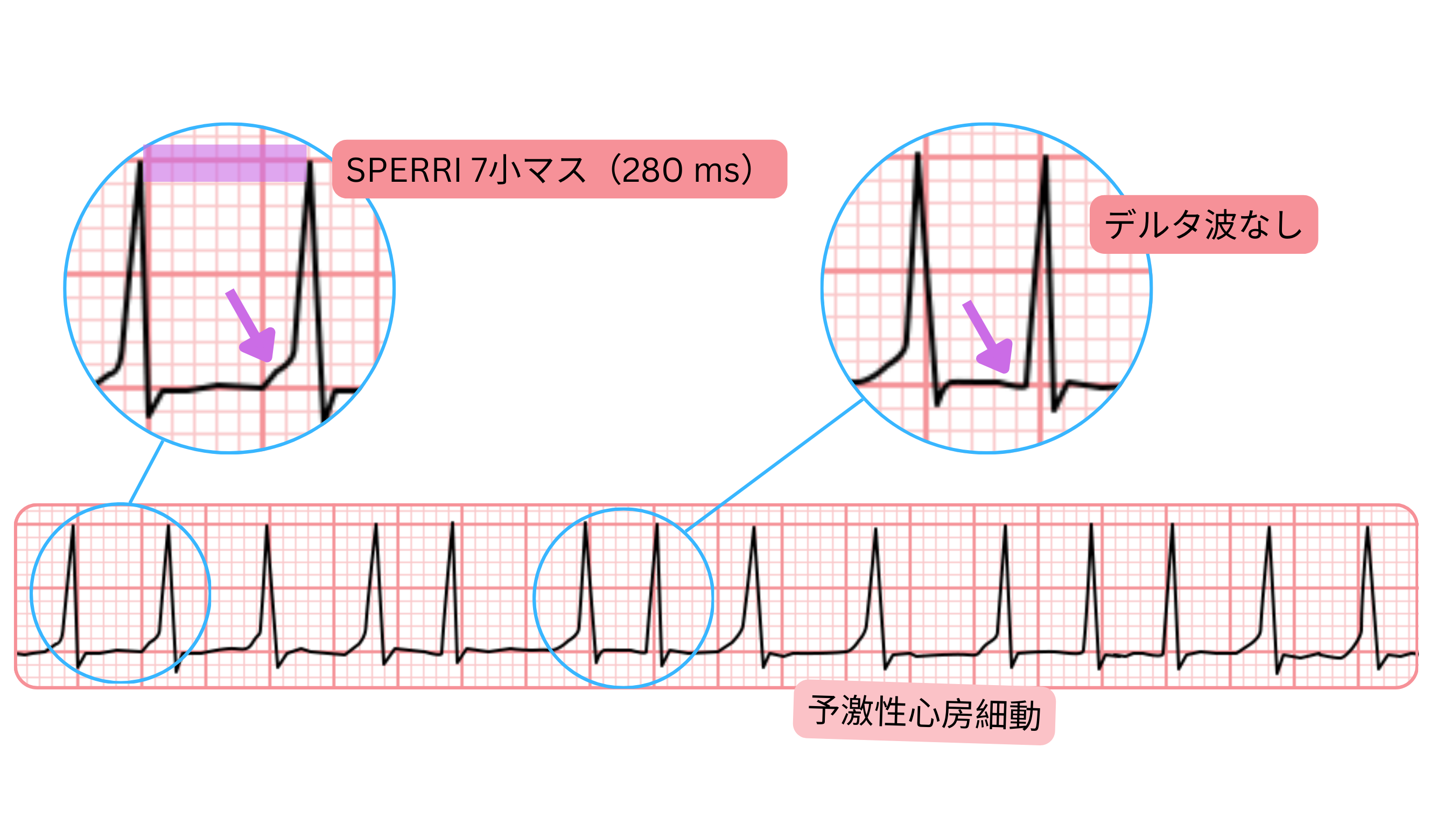 SPERRIが280ミリ秒と長く、デルタ波を認めない予激性心房細動の心電図。