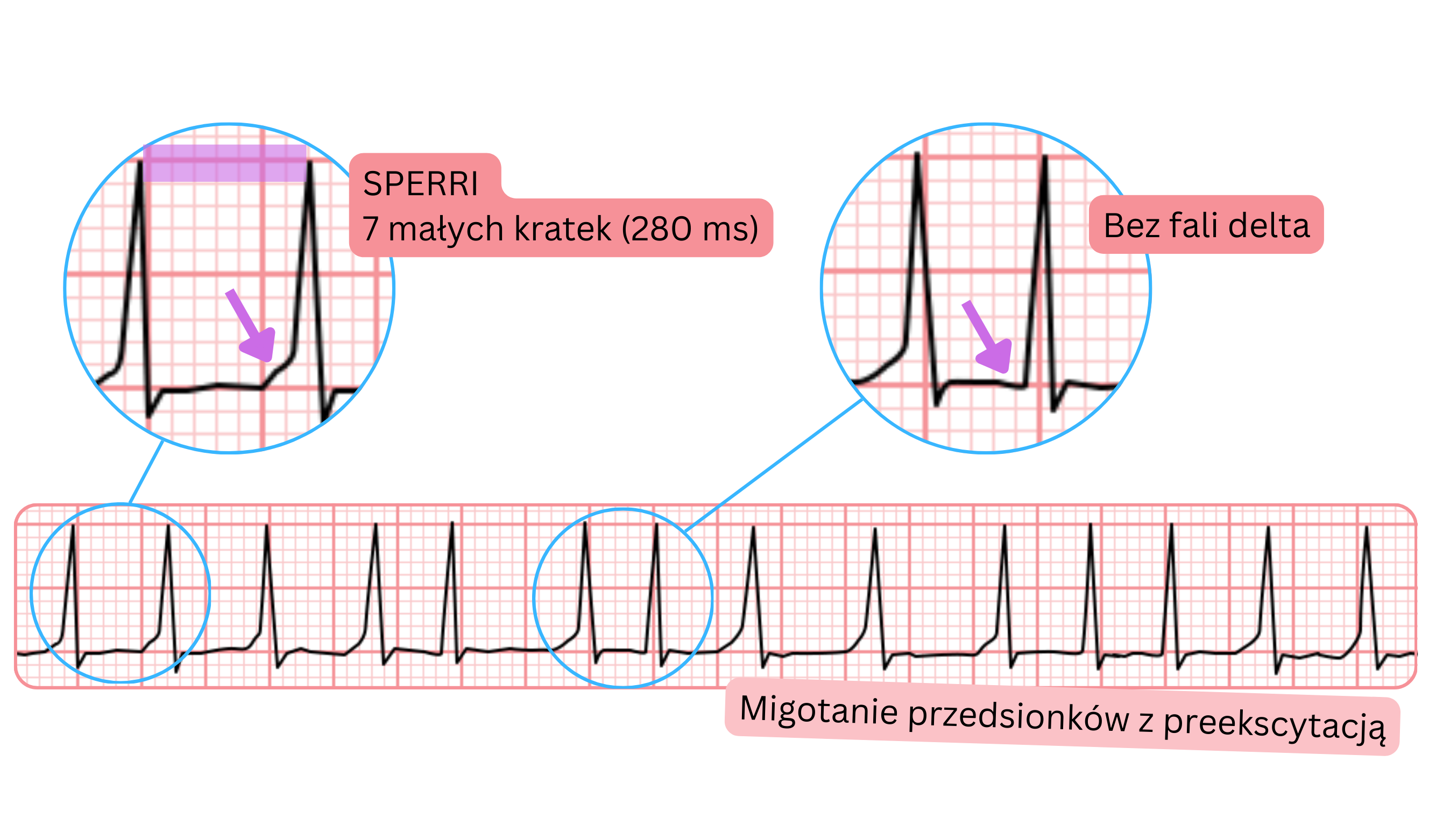 Preekscytowane migotanie przedsionków z dłuższym SPERRI 280 ms i brakiem fali delta w EKG.