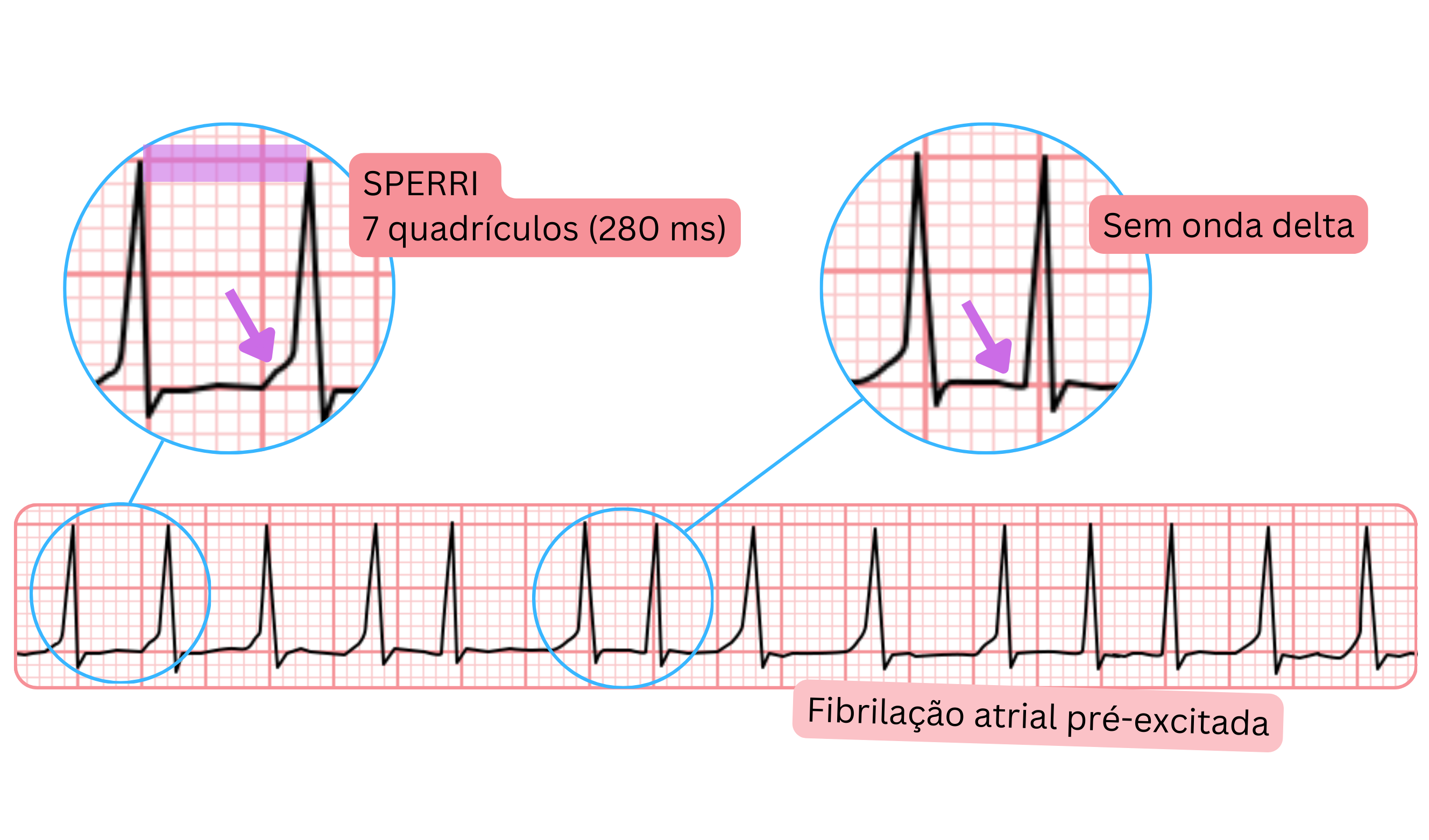 Fibrilação atrial pré-excitada com SPERRI mais longo de 280 ms e ausência de onda delta no ECG.