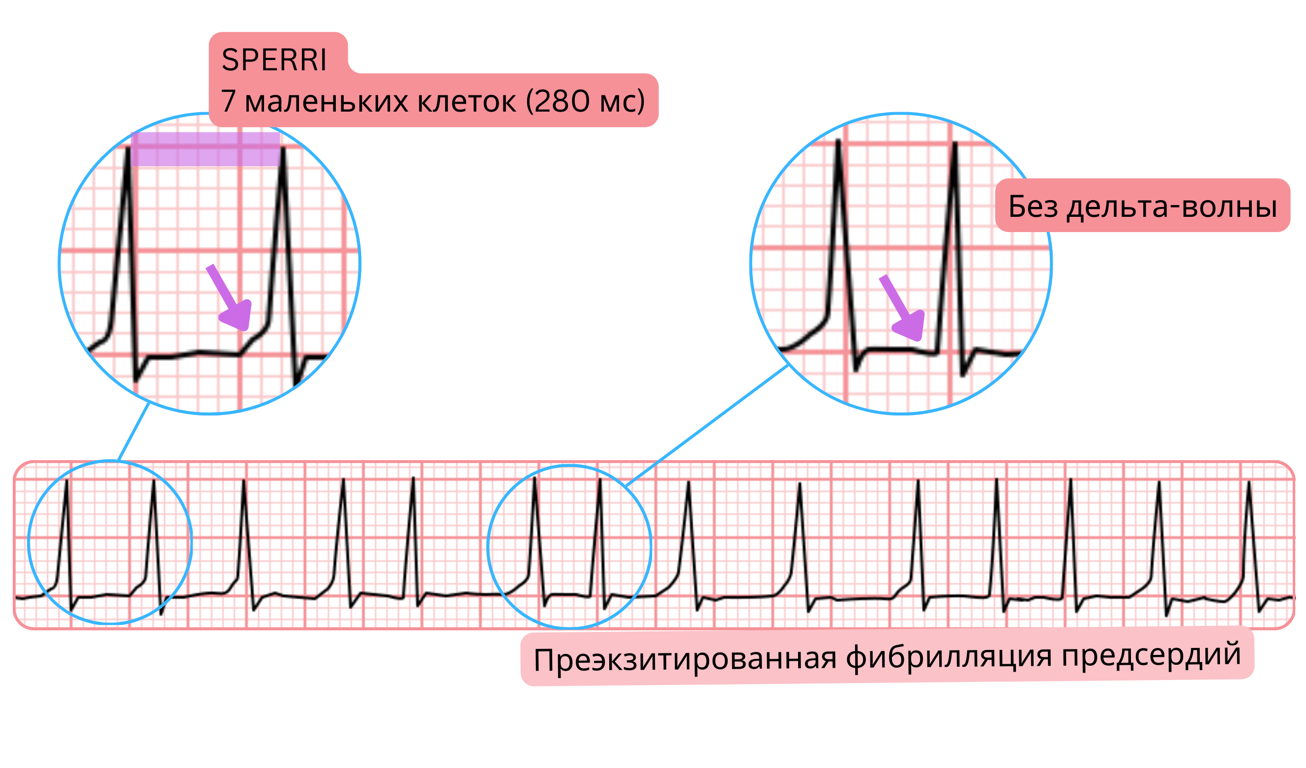 Предвозбуждённая фибрилляция предсердий с более длительным SPERRI 280 мс и отсутствием дельта-волны на ЭКГ.