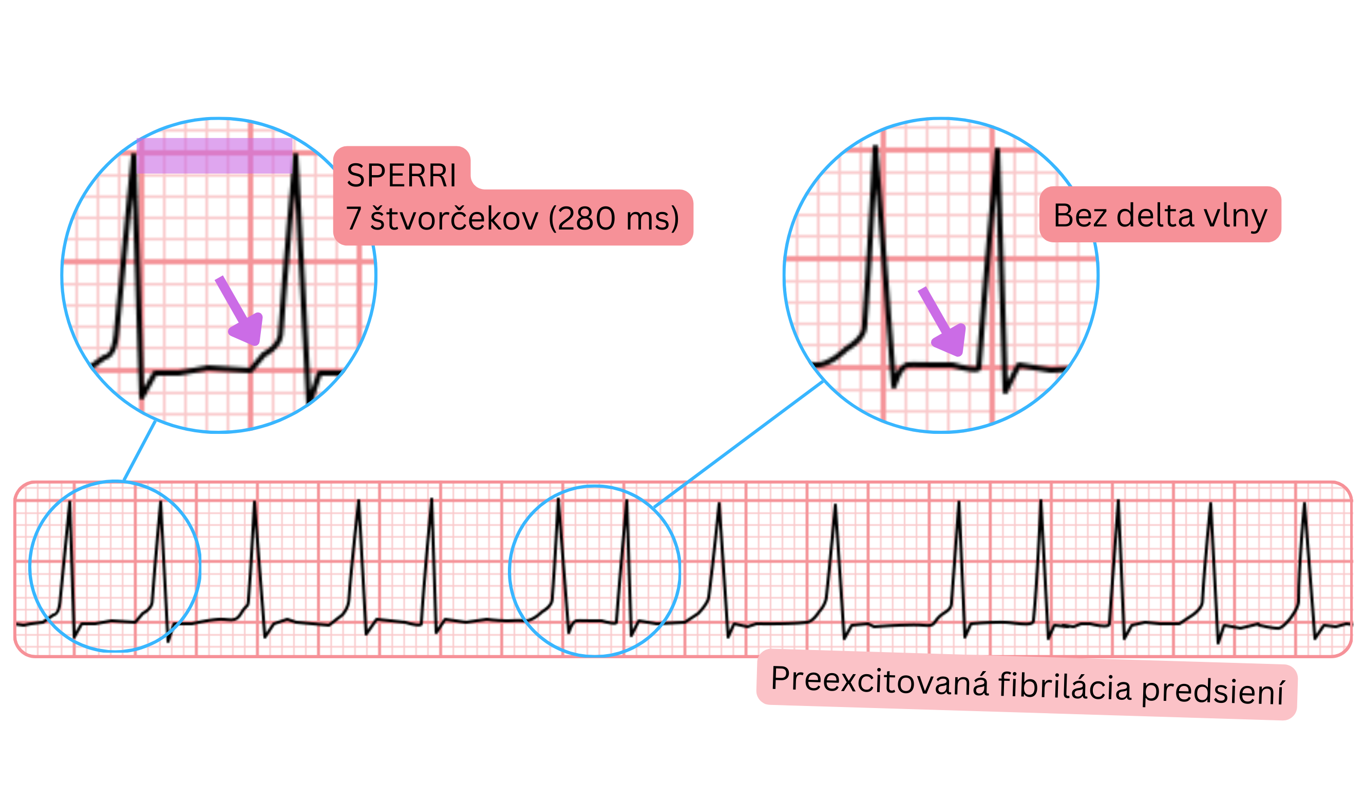 Preexcitovaná fibrilácia predsiení s dlhším SPERRI 280 ms a bez delta vlny na EKG.