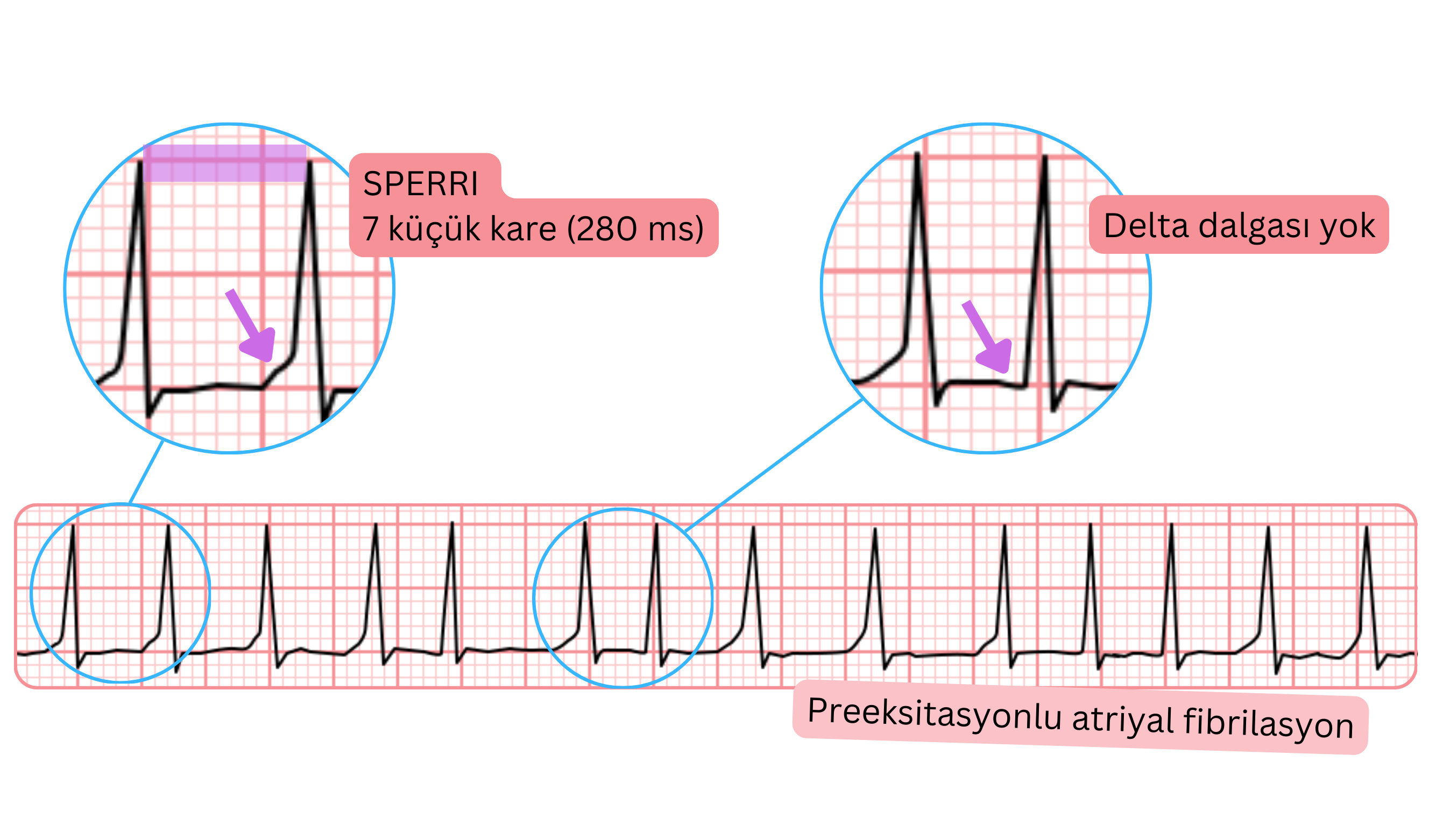 EKG’de SPERRI’nin 280 ms olduğu, delta dalgası olmayan preeksiytasyonlu atriyal fibrilasyon.