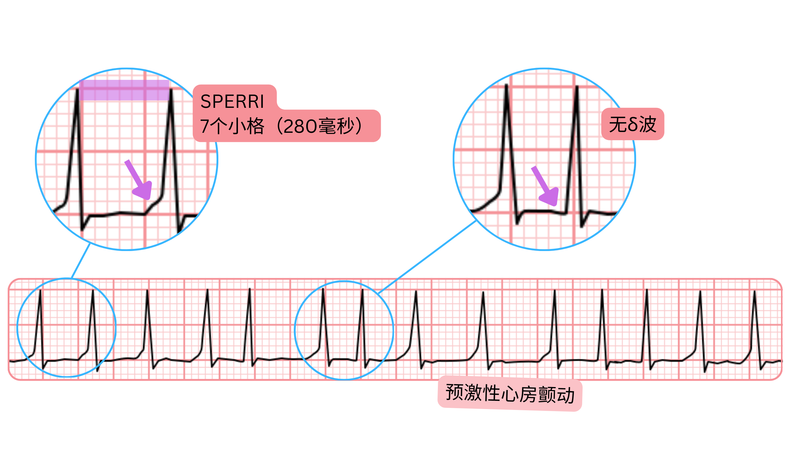心电图上显示SPERRI为280毫秒且无δ波的预激性心房颤动。
