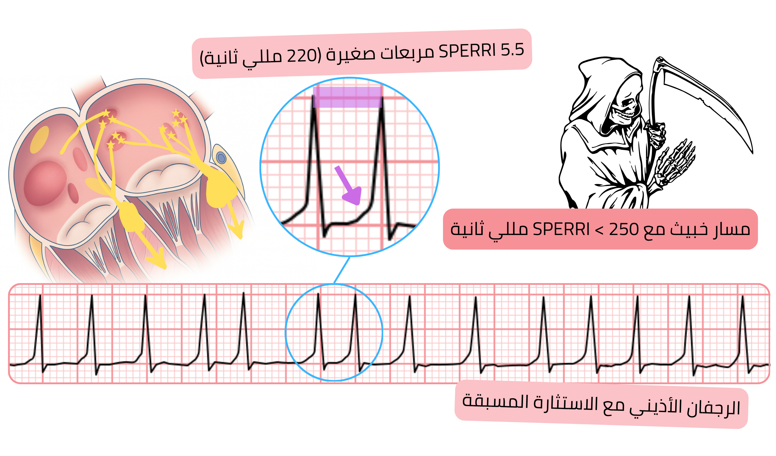 الرجفان الأذيني مع الاستثارة المسبقة مع SPERRI قصير أقل من 250 مللي ثانية على تخطيط القلب.