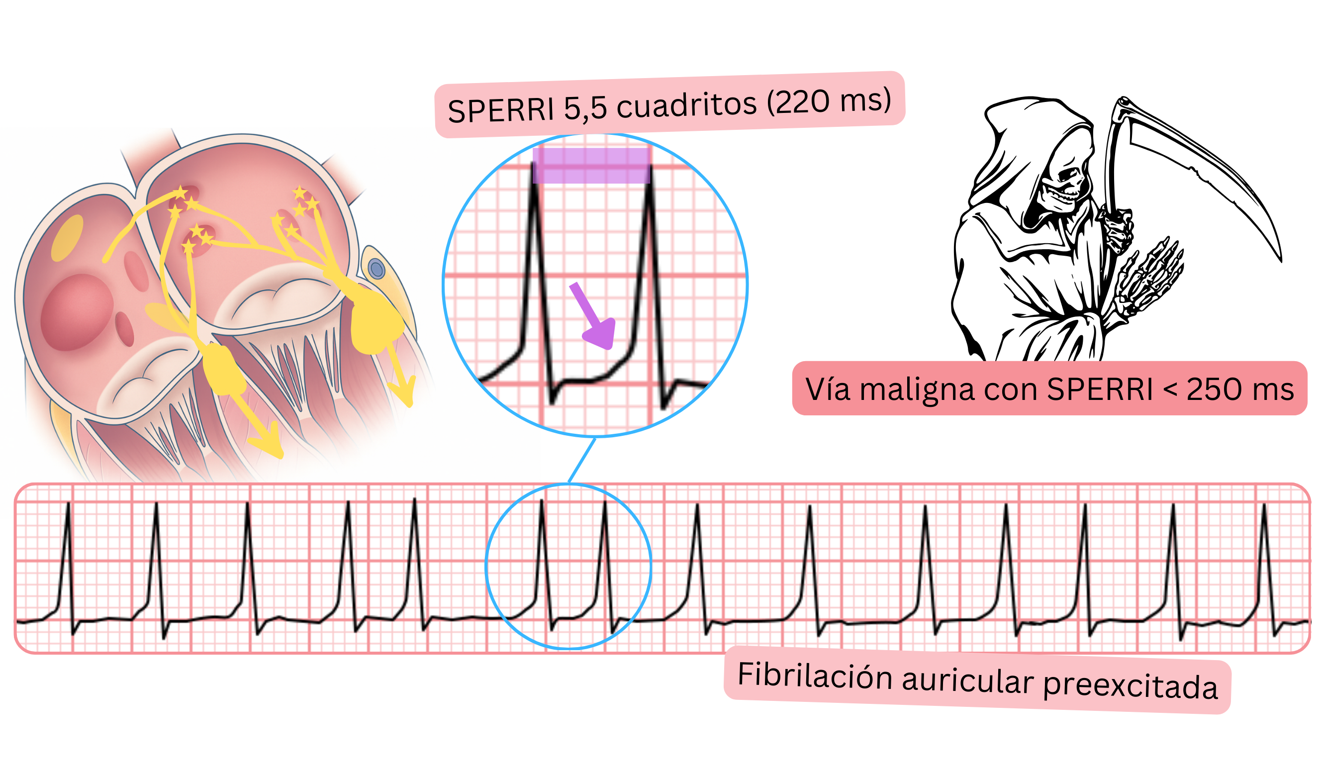 Fibrilación auricular preexcitada con SPERRI corto inferior a 250 ms en el ECG.