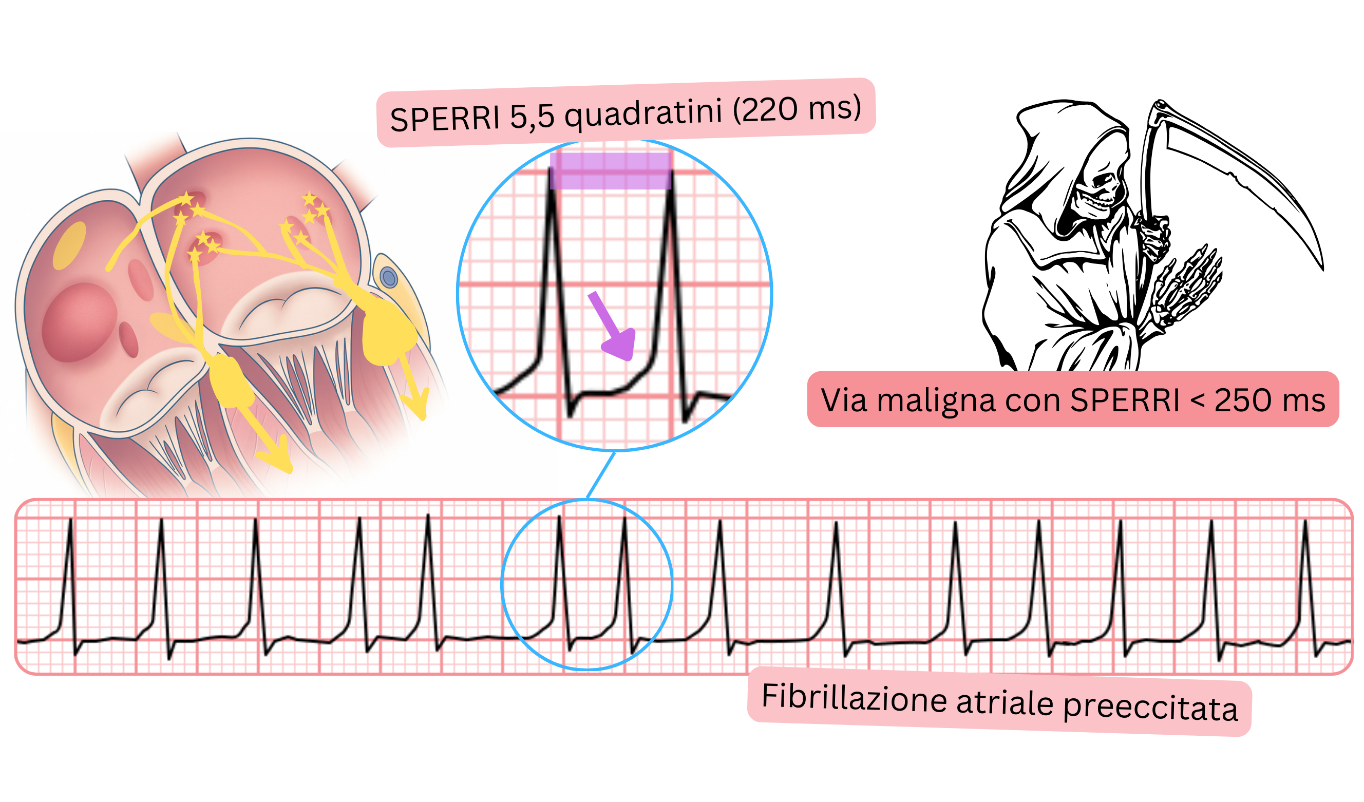 Fibrillazione atriale preeccitata con SPERRI breve inferiore a 250 ms all’ECG.