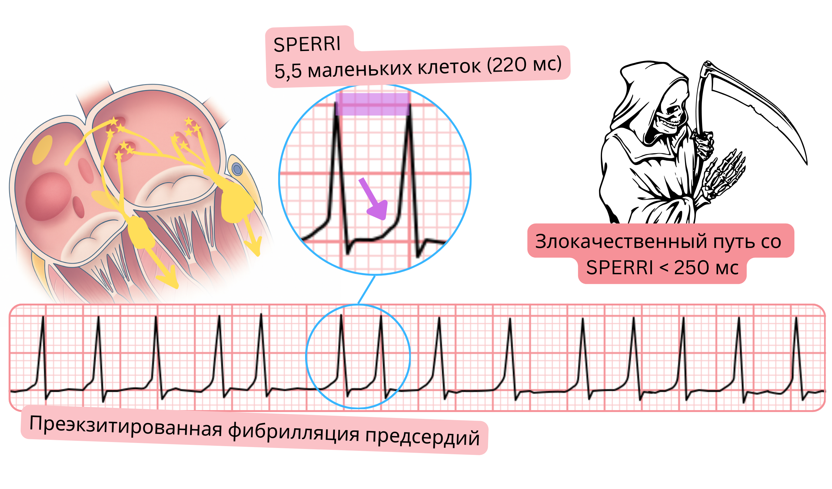 Предвозбуждённая фибрилляция предсердий с коротким SPERRI менее 250 мс на ЭКГ.