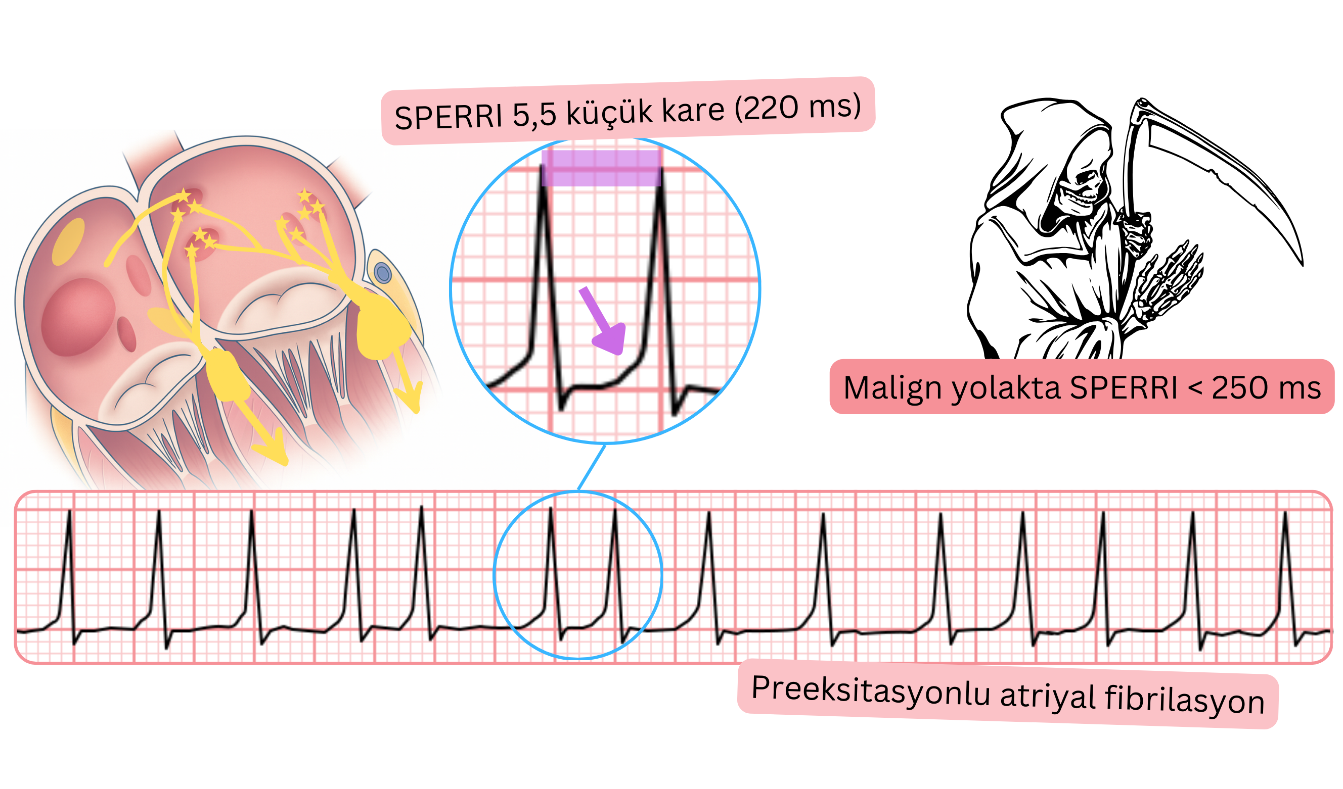 EKG’de SPERRI’nin 250 ms’nin altında olduğu preeksiytasyonlu atriyal fibrilasyon.