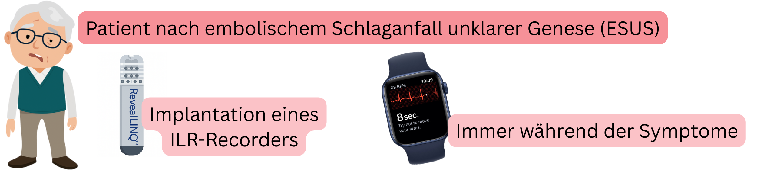 Schema zur Detektion von Vorhofflimmern bei Patienten nach ESUS mittels Implantation eines ILR-Recorders und EKG-Aufzeichnung während der Symptome.