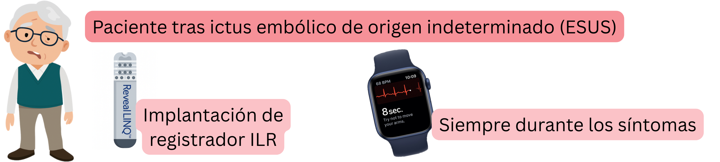 Esquema de la detección de fibrilación auricular en pacientes tras un ESUS mediante la implantación de un registrador ILR y el registro de ECG durante los síntomas.