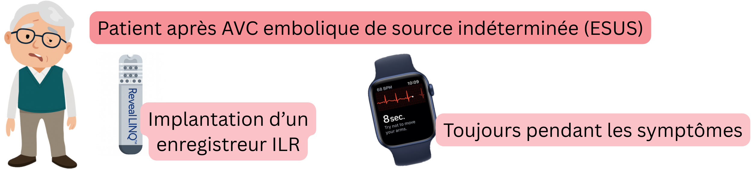 Schéma de la détection de la fibrillation atriale chez les patients après un ESUS à l’aide d’un enregistreur ILR implantable et d’enregistrements ECG pendant les symptômes.