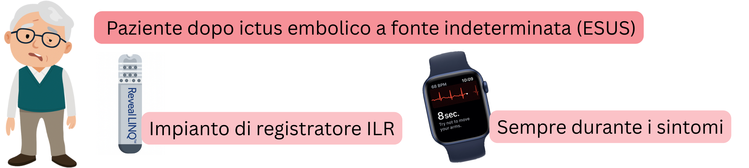 Schema della rilevazione della fibrillazione atriale nei pazienti dopo ESUS mediante impianto di un registratore ILR e registrazione ECG durante i sintomi.