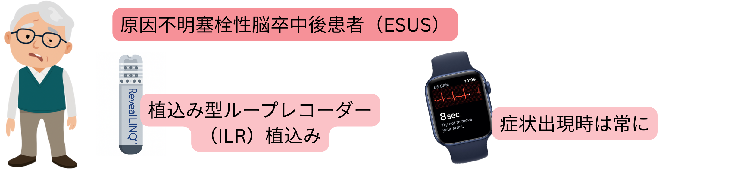 ESUS後患者において、植込み型ループレコーダー（ILR）と症状出現時の心電図記録を用いた心房細動検出の模式図。