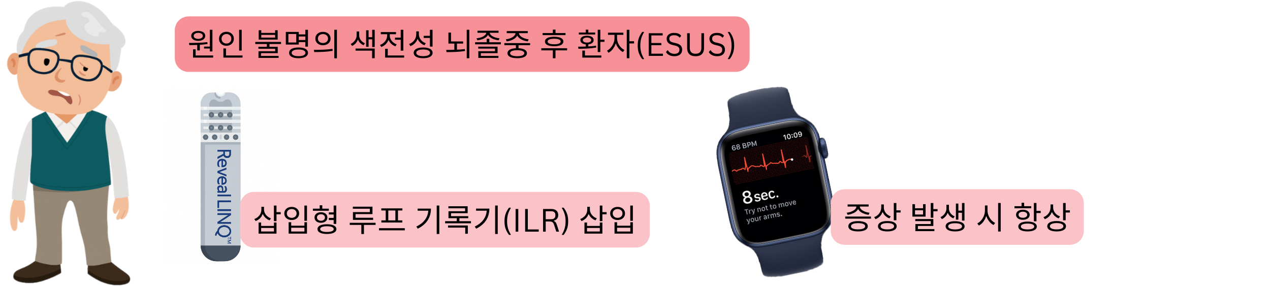 ESUS 이후 환자에서 삽입형 루프 기록기(ILR)와 증상 발생 시 심전도 기록을 이용한 심방세동 검출 도식.