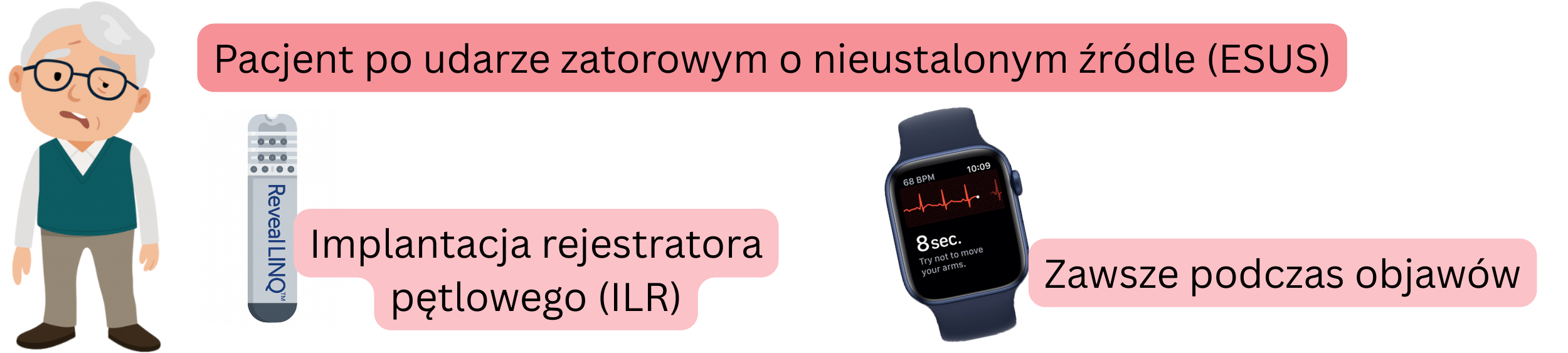 Schemat wykrywania migotania przedsionków u pacjentów po ESUS z implantacją rejestratora ILR oraz zapisem EKG podczas objawów.