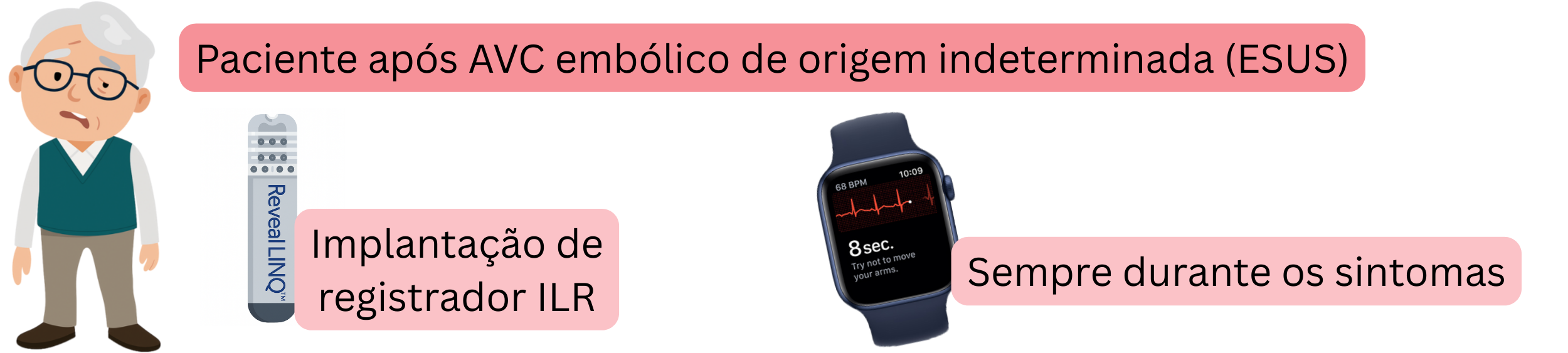 Esquema da deteção da fibrilação atrial em doentes após ESUS através da implantação de um registador ILR e registo de ECG durante os sintomas.