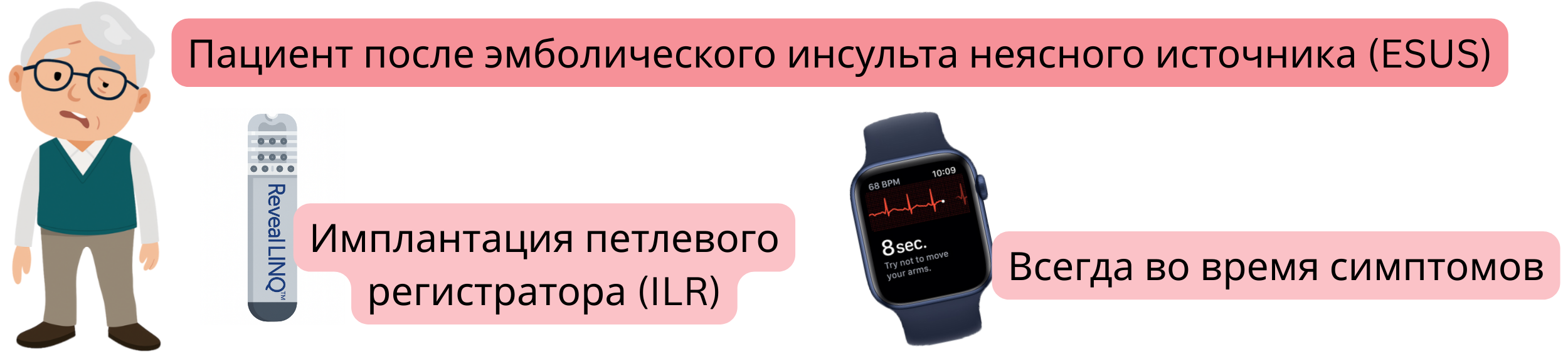 Схема выявления фибрилляции предсердий у пациентов после ESUS с имплантацией петлевого регистратора ILR и записью ЭКГ во время симптомов.