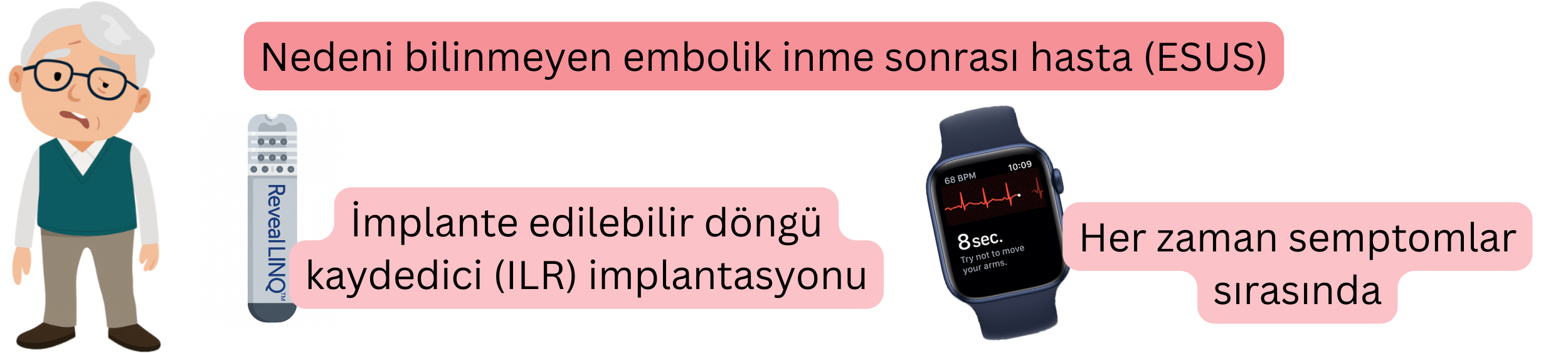 ESUS sonrası hastalarda implant edilebilir loop recorder (ILR) ve semptomlar sırasında EKG kaydı kullanılarak atriyal fibrilasyonun saptanmasını gösteren şema.