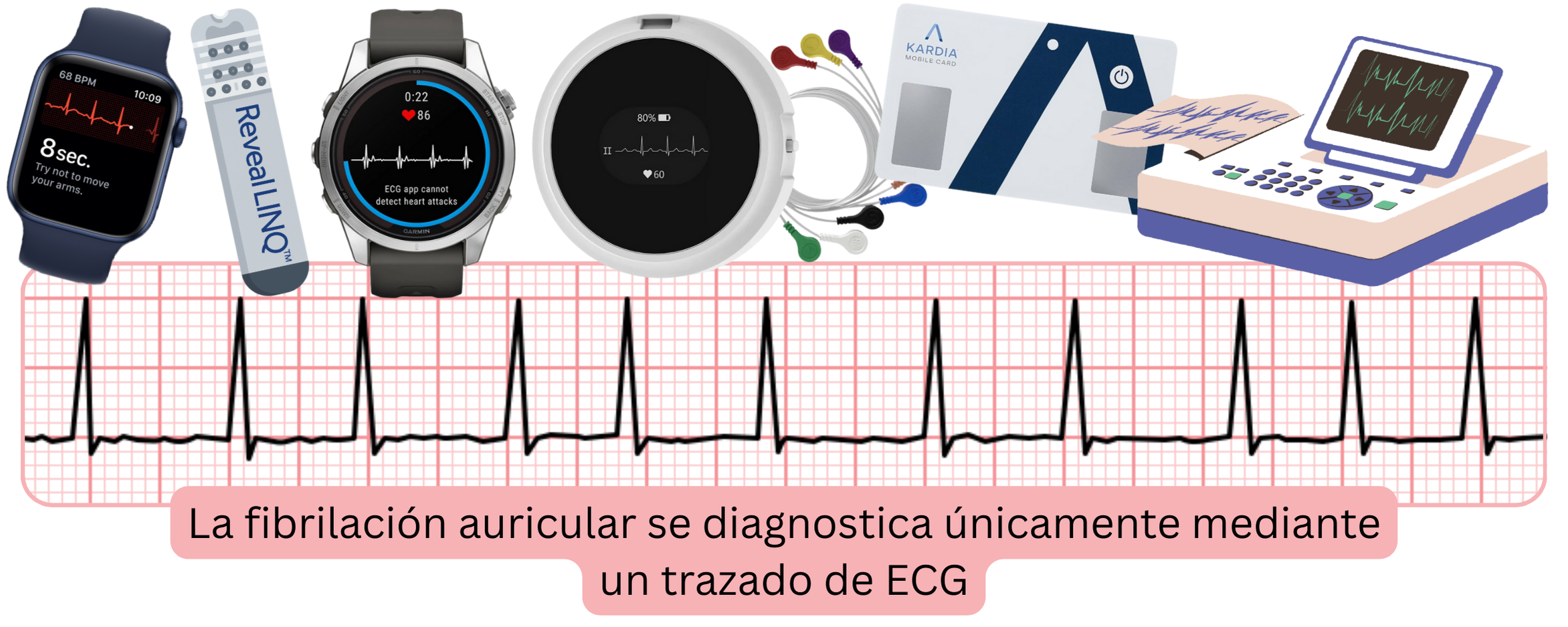 Infografía que muestra el diagnóstico de la fibrilación auricular mediante registros de ECG procedentes de dispositivos de cribado y monitorización.