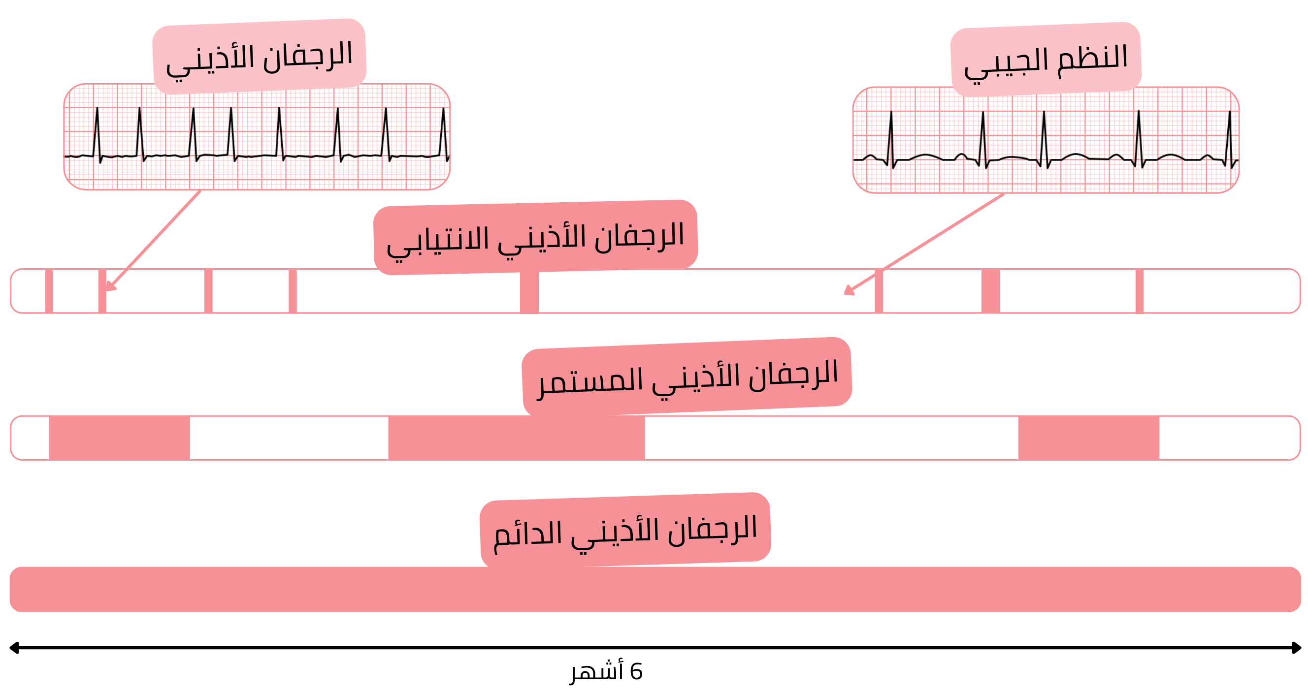 مخطط يوضح أنواع الرجفان الأذيني، بما في ذلك الانتيابي والمستمر والدائم، مقارنةً بالنظم الجيبي عبر الزمن.