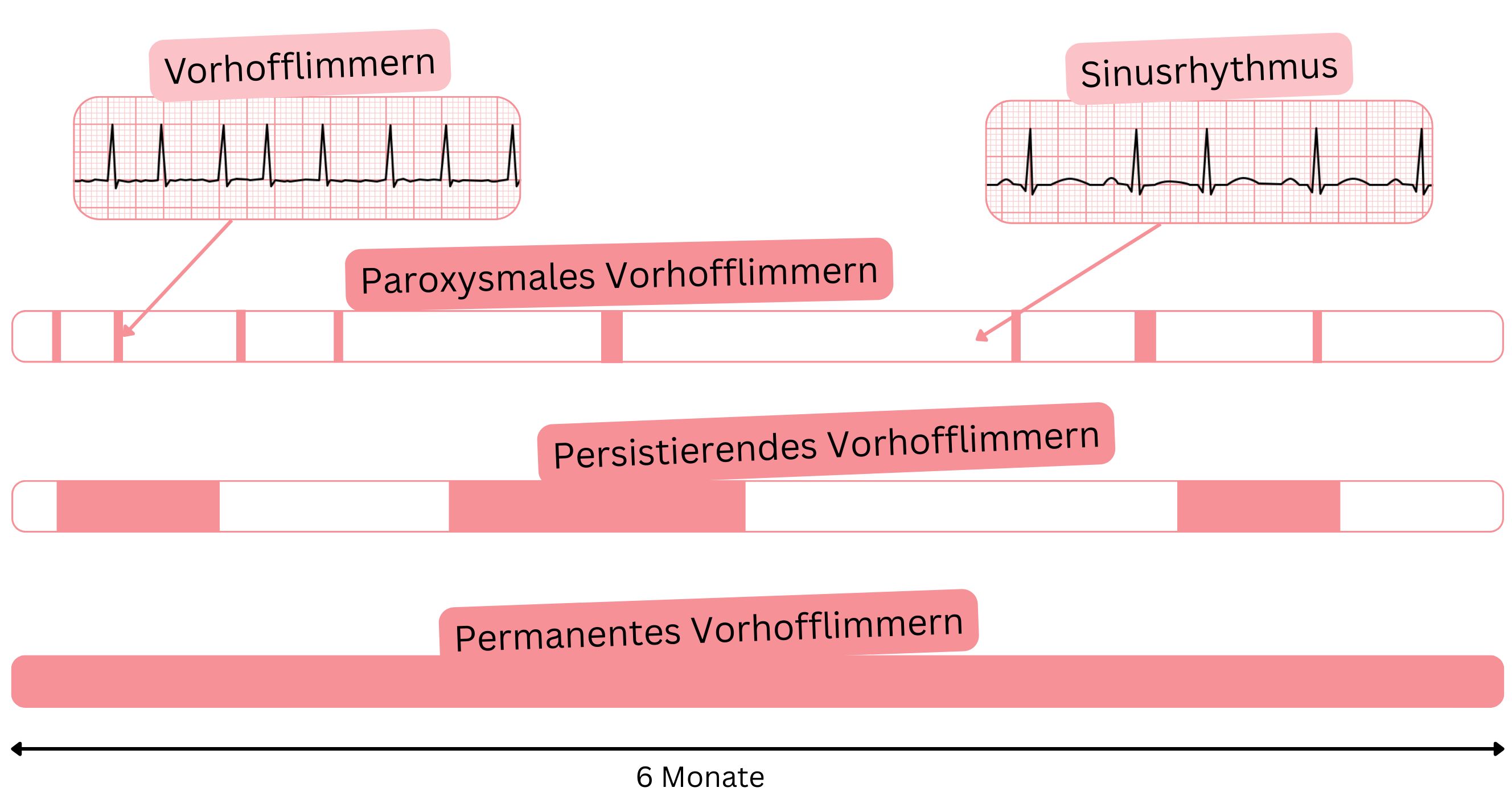 Schema der Typen des Vorhofflimmerns mit Darstellung der paroxysmalen, persistierenden und permanenten Form im Vergleich zum Sinusrhythmus im Zeitverlauf.