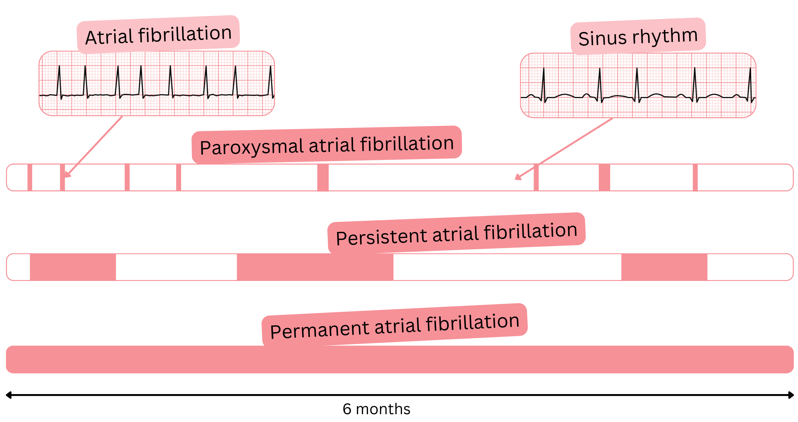Diagram of atrial fibrillation types illustrating paroxysmal, persistent, and permanent atrial fibrillation compared with sinus rhythm over time.