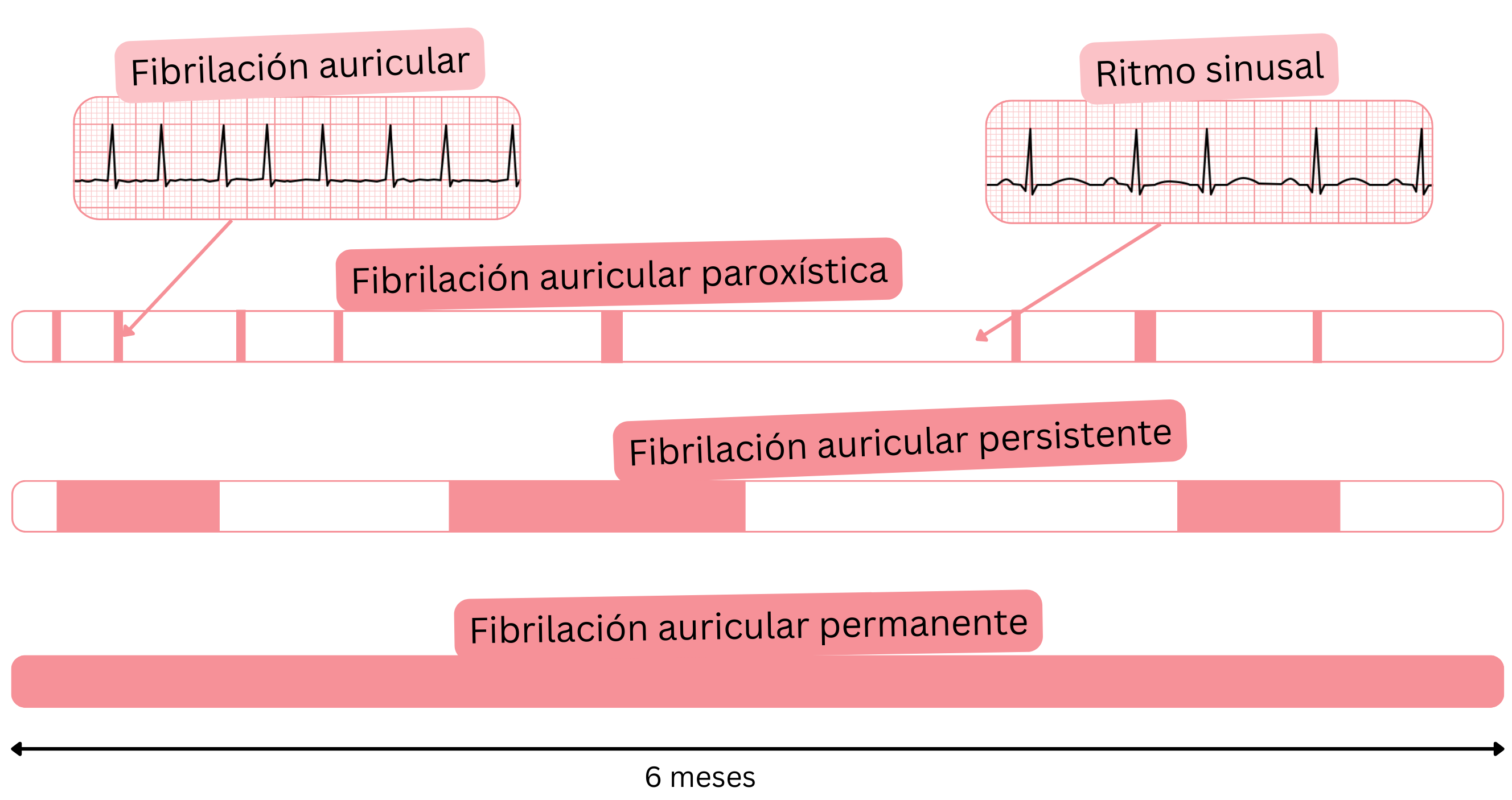 Esquema de los tipos de fibrilación auricular que muestra la fibrilación auricular paroxística, persistente y permanente en comparación con el ritmo sinusal a lo largo del tiempo.
