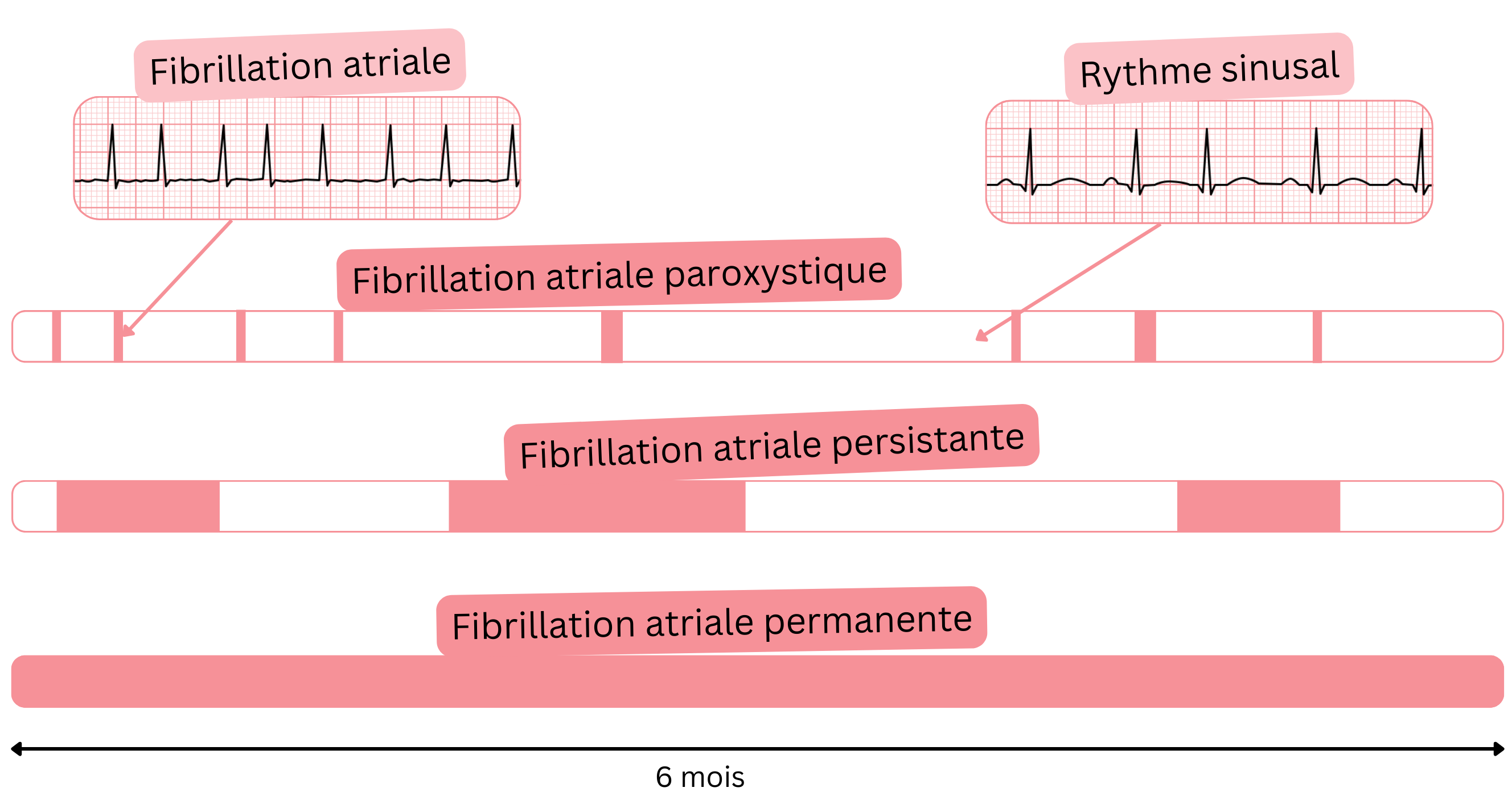 Schéma des types de fibrillation atriale illustrant les formes paroxystique, persistante et permanente, comparées au rythme sinusal au fil du temps.