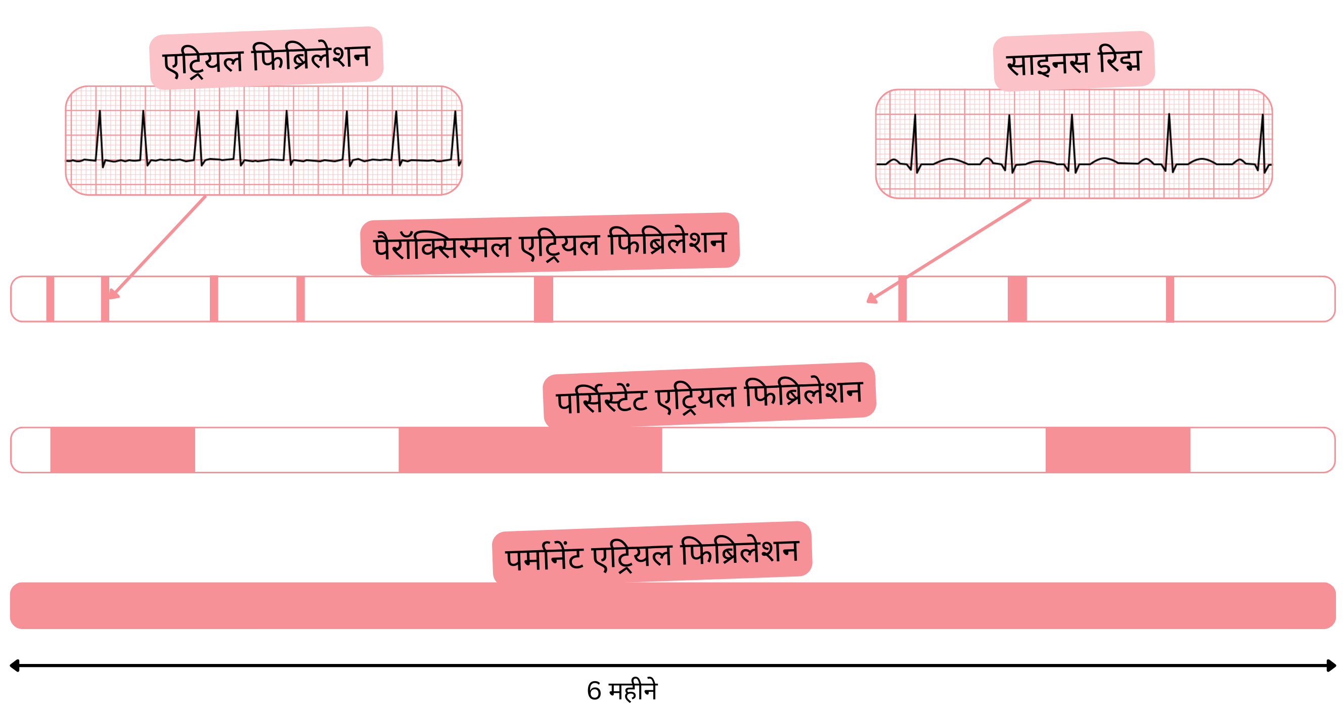 आरेख जो एट्रियल फिब्रिलेशन के प्रकारों को दर्शाता है, जिसमें पैरॉक्सिस्मल, पर्सिस्टेंट और परमानेंट एट्रियल फिब्रिलेशन को समय के साथ साइनस रिद्म से तुलना की गई है।