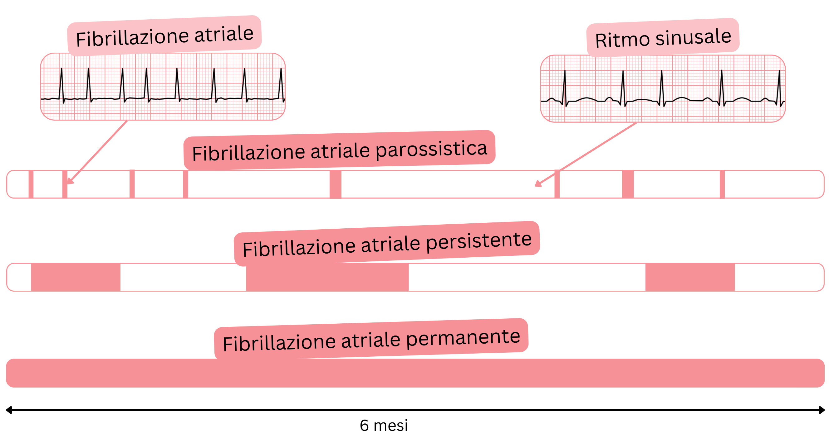 Schema dei tipi di fibrillazione atriale che illustra le forme parossistica, persistente e permanente a confronto con il ritmo sinusale nel tempo.