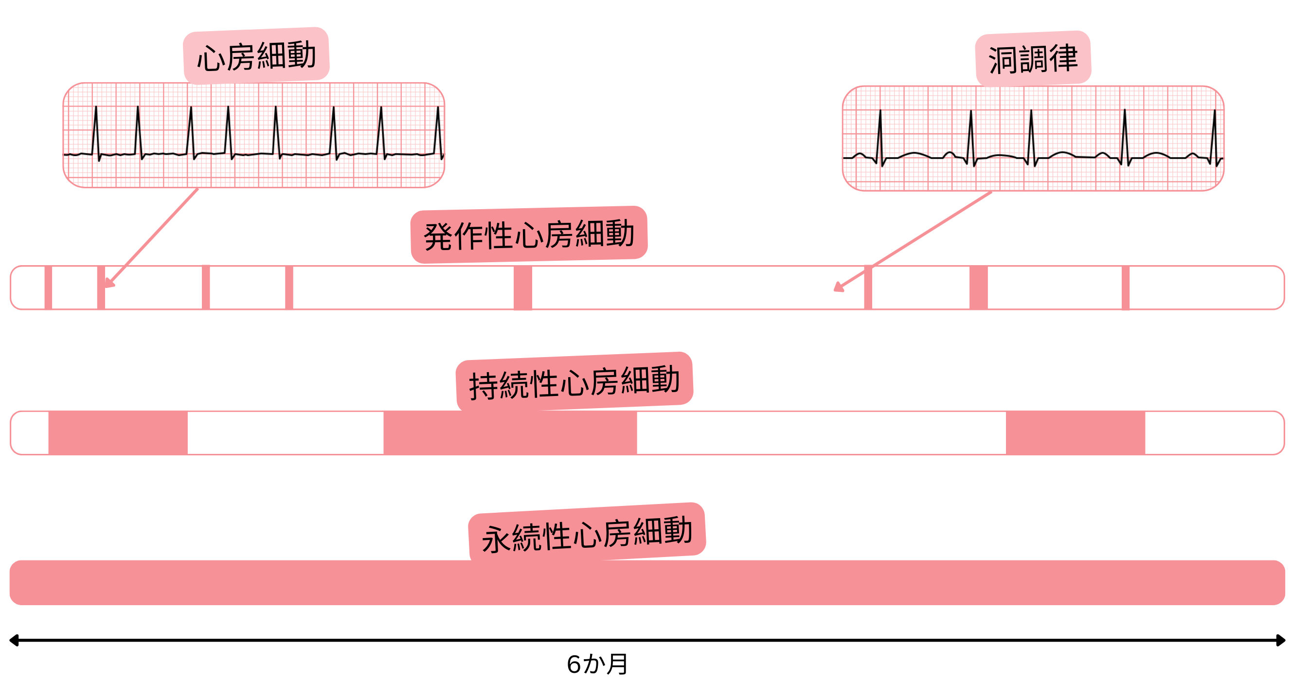 洞調律と比較して、発作性・持続性・永続性の心房細動のタイプを時間軸で示す模式図。