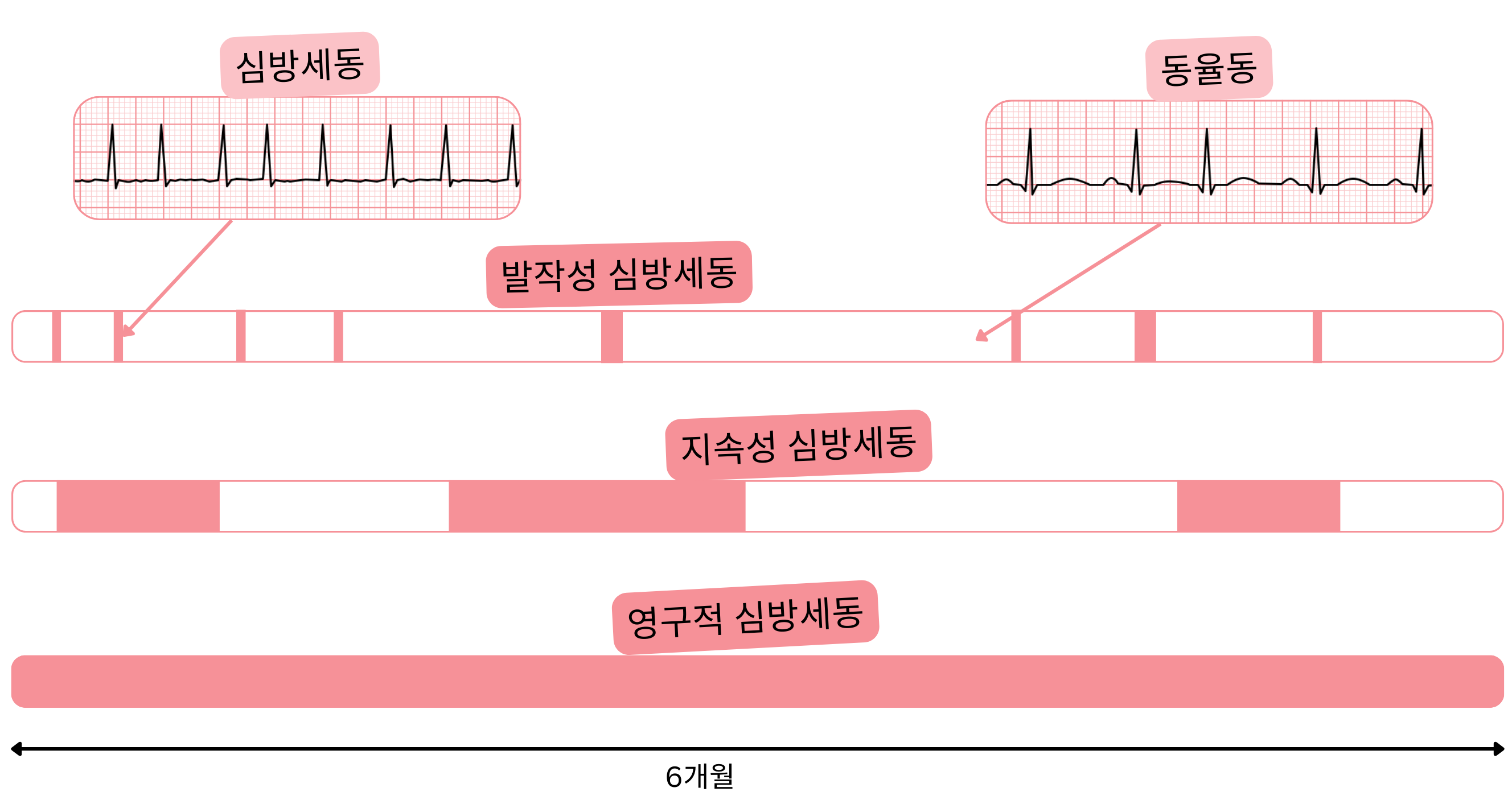 시간 경과에 따라 동율동과 비교하여 발작성, 지속성, 영구성 심방세동 유형을 나타낸 도식.