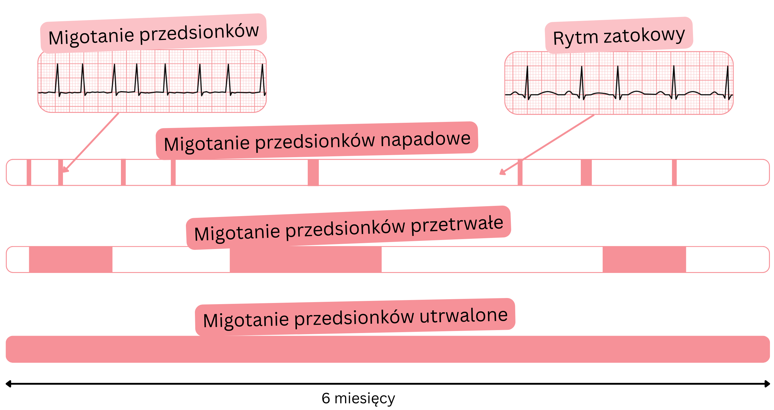 Schemat typów migotania przedsionków przedstawiający postać napadową, przetrwałą i utrwaloną w porównaniu z rytmem zatokowym w czasie.
