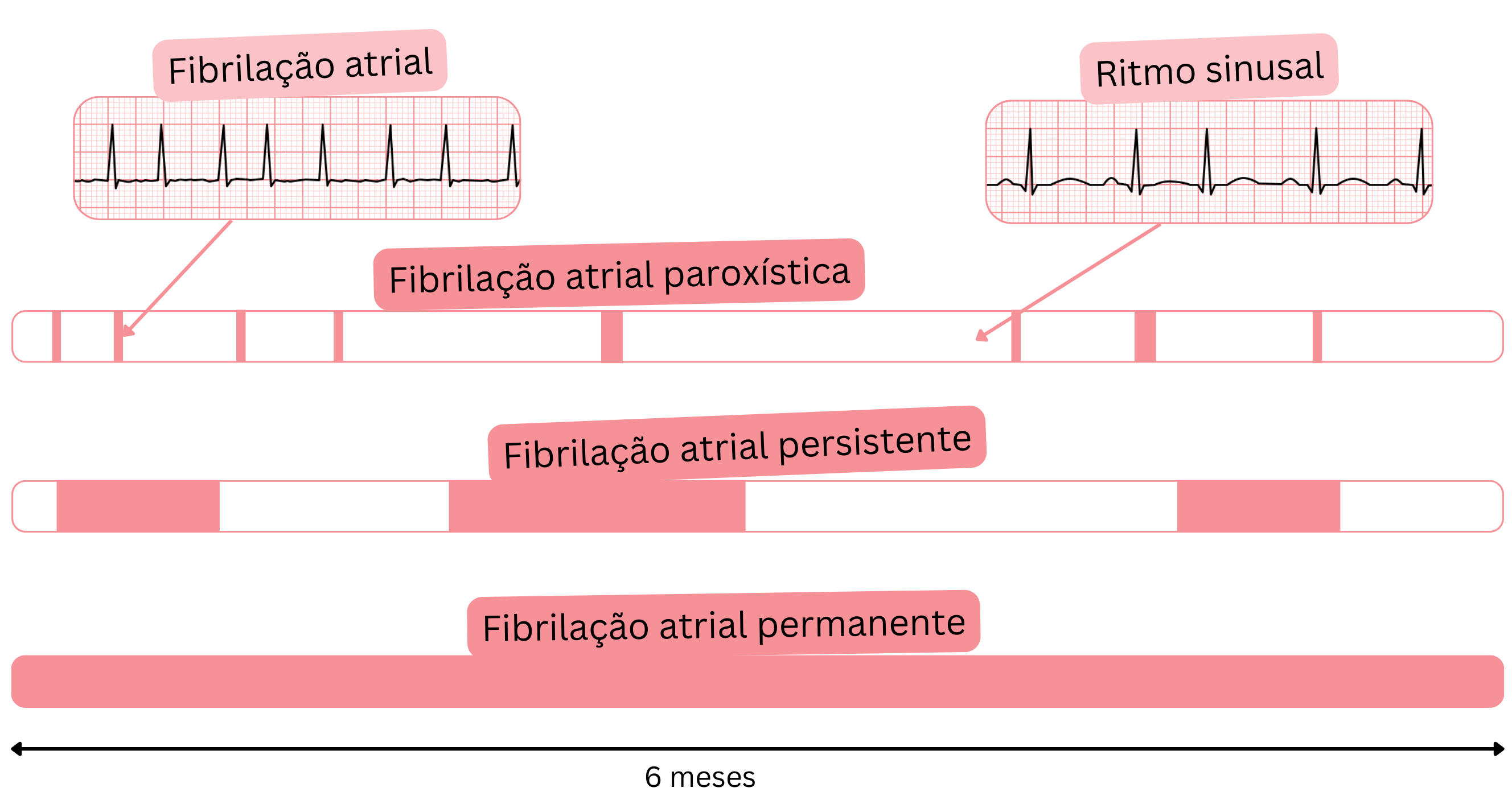 Esquema dos tipos de fibrilação atrial ilustrando as formas paroxística, persistente e permanente em comparação com o ritmo sinusal ao longo do tempo.