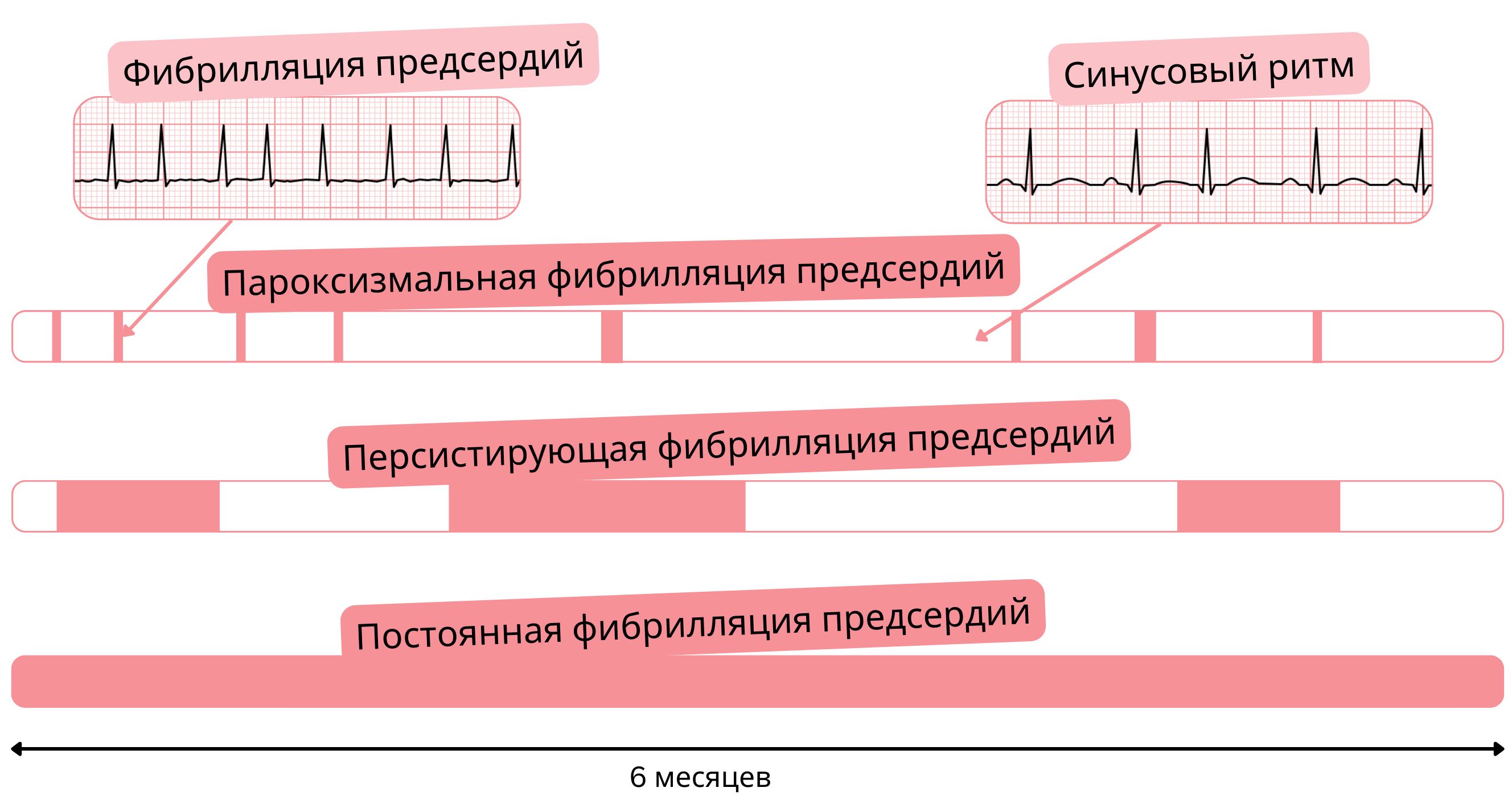 Схема типов фибрилляции предсердий, демонстрирующая пароксизмальную, персистирующую и постоянную формы по сравнению с синусовым ритмом во времени.