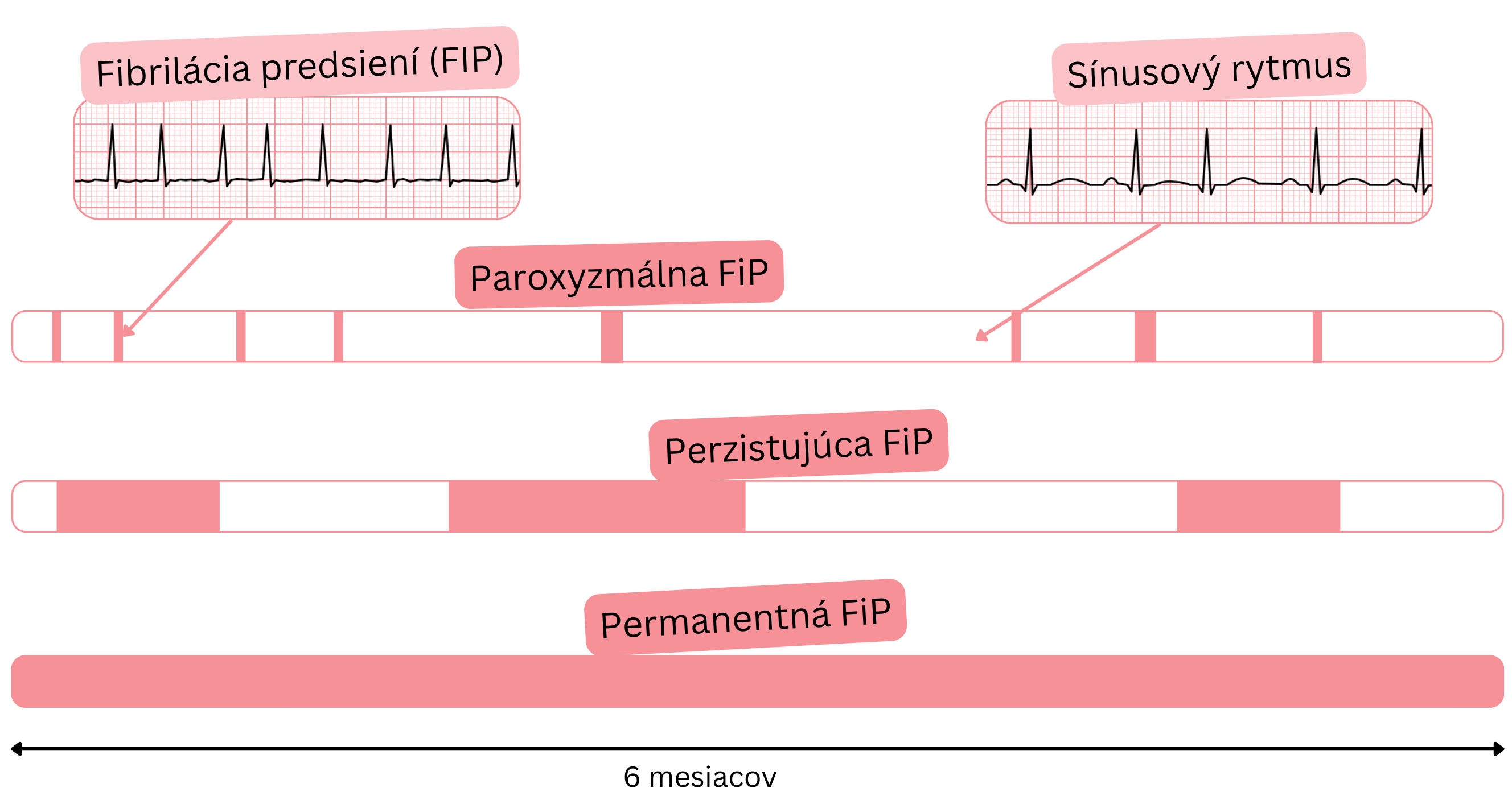 Schéma typov fibrilácie predsiení znázorňujúca paroxyzmálnu, perzistujúcu a permanentnú fibriláciu predsiení v porovnaní so sínusovým rytmom v čase.