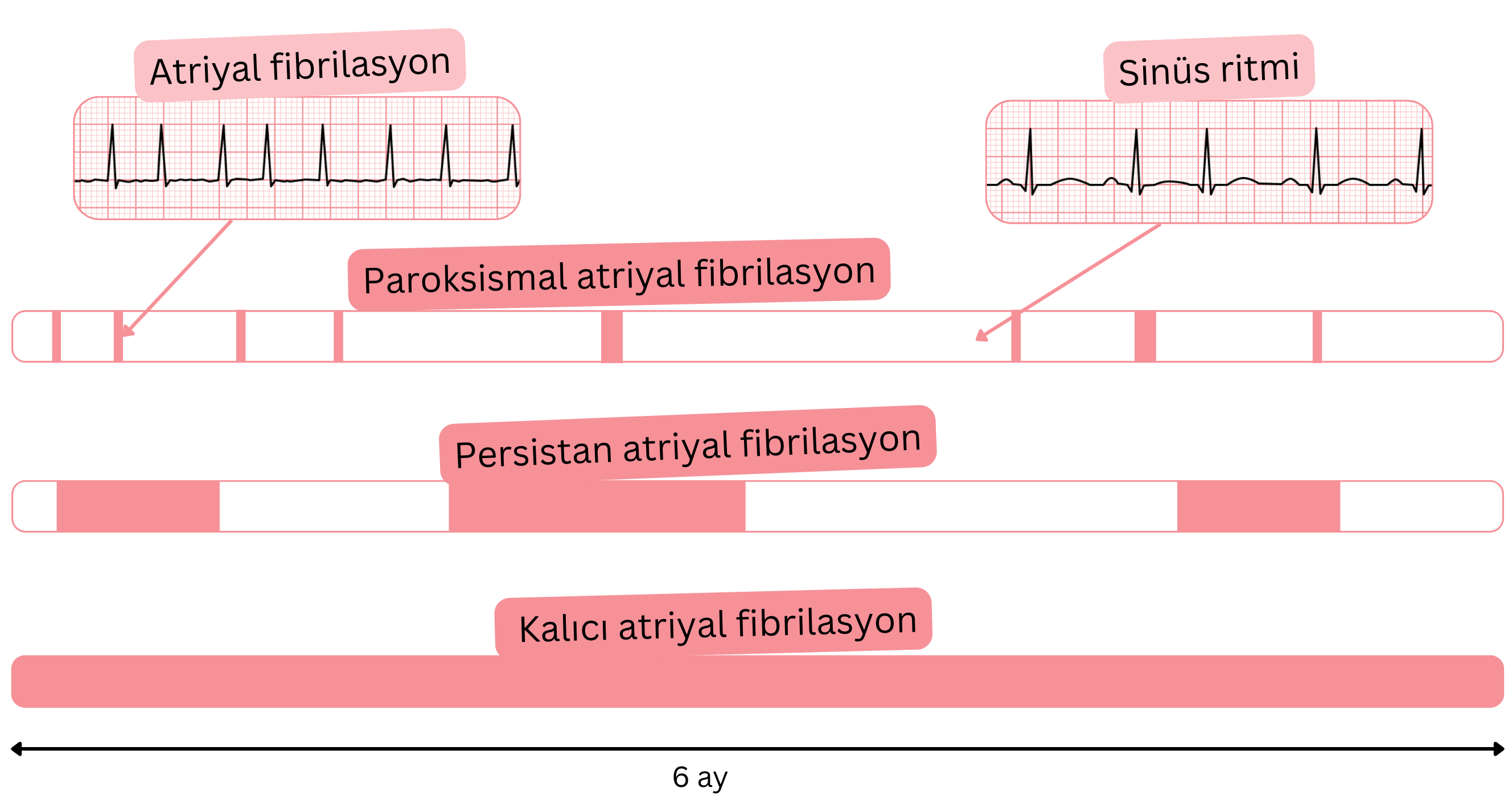 Zaman içinde sinüs ritmi ile karşılaştırmalı olarak paroksismal, persistan ve kalıcı atriyal fibrilasyon tiplerini gösteren şema.