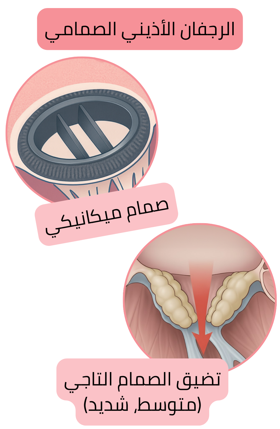 رسم توضيحي للرجفان الأذيني الصمامي في وجود صمام ميكانيكي وتضيق الصمام التاجي المتوسط إلى الشديد.