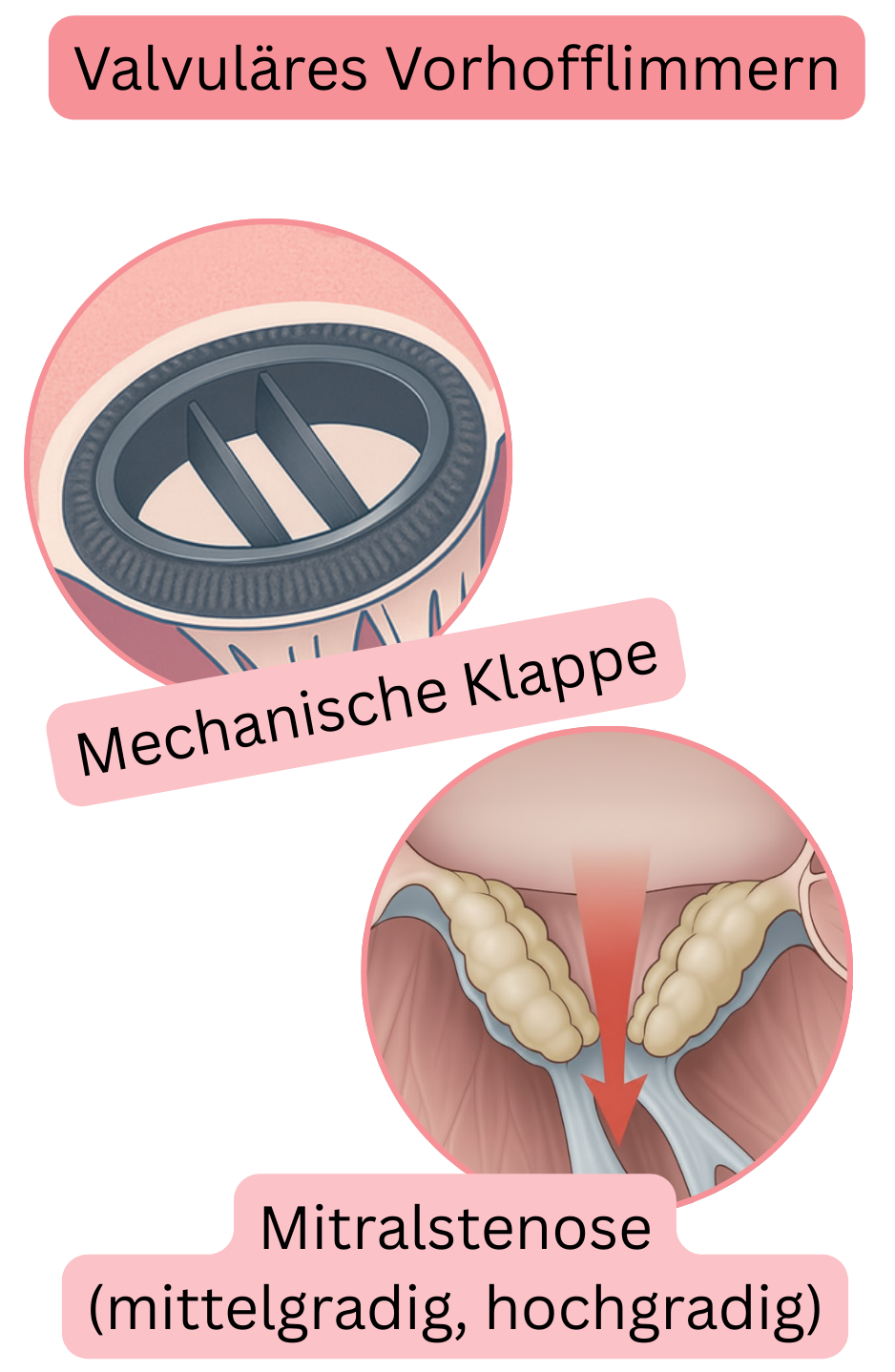 Illustration des valvulären Vorhofflimmerns bei mechanischer Herzklappe und mittelgradiger bis schwerer Mitralstenose.
