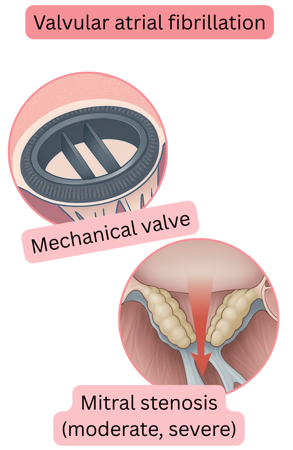 Illustration of valvular atrial fibrillation in the presence of a mechanical heart valve and moderate to severe mitral stenosis.