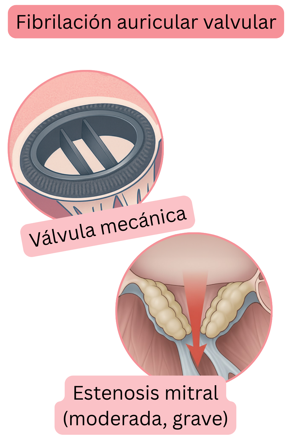 Ilustración de la fibrilación auricular valvular en presencia de una válvula mecánica y estenosis mitral moderada a grave.