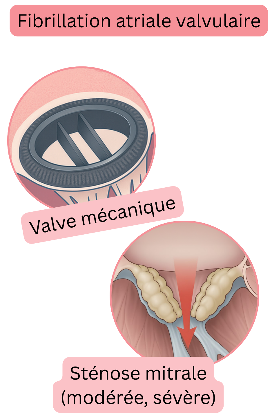 Illustration de la fibrillation atriale valvulaire en cas de valve mécanique et de sténose mitrale modérée à sévère.