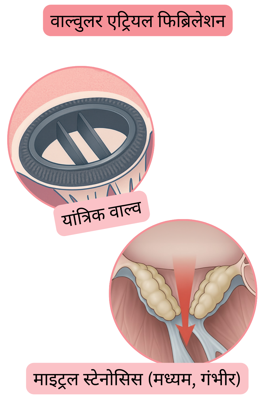 चित्रण जो यांत्रिक हृदय वाल्व और मध्यम से गंभीर माइट्रल स्टेनोसिस की उपस्थिति में वाल्वुलर एट्रियल फिब्रिलेशन को दर्शाता है।