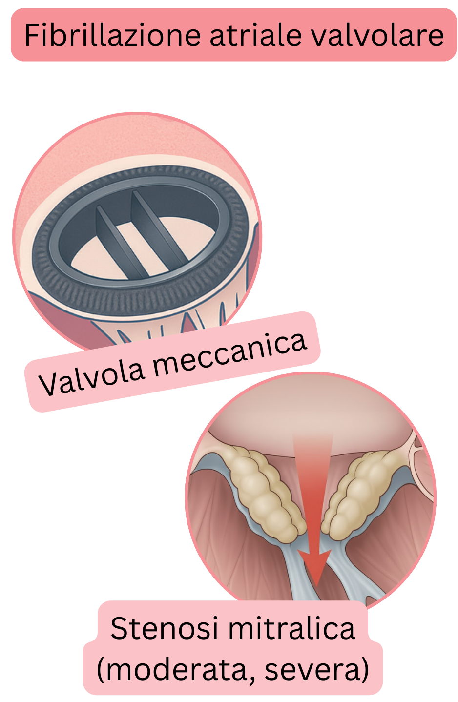 Illustrazione della fibrillazione atriale valvolare in presenza di valvola meccanica e stenosi mitralica moderata o severa.