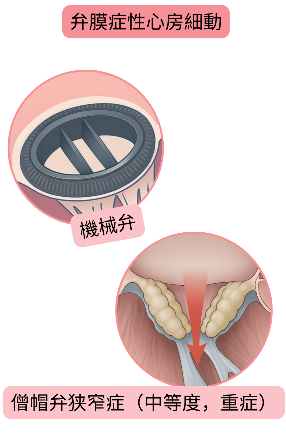 機械弁および中等度から重度の僧帽弁狭窄を伴う弁膜症性心房細動を示す図。