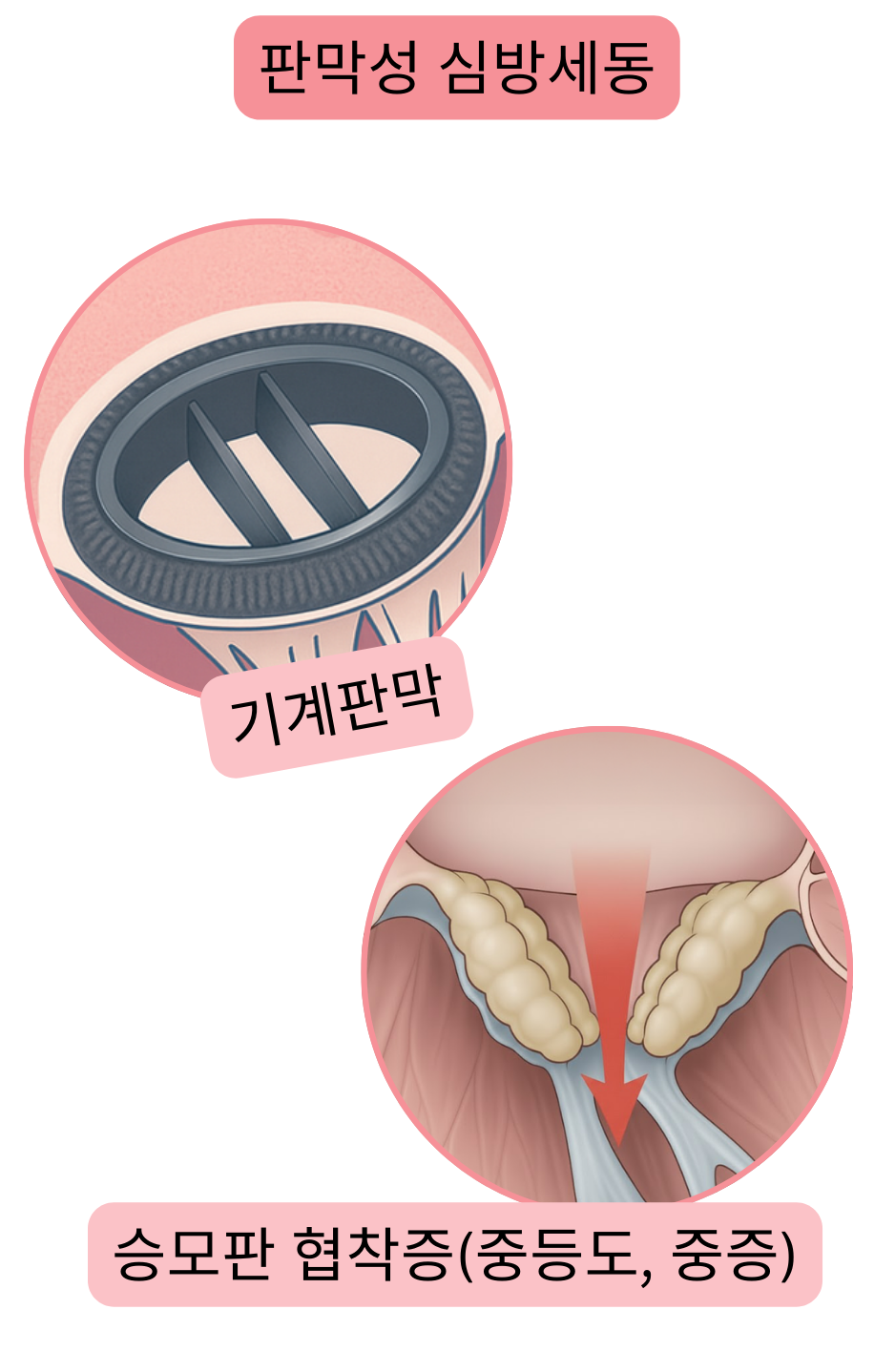 기계판막과 중등도에서 중증의 승모판 협착이 동반된 판막성 심방세동을 나타낸 그림.