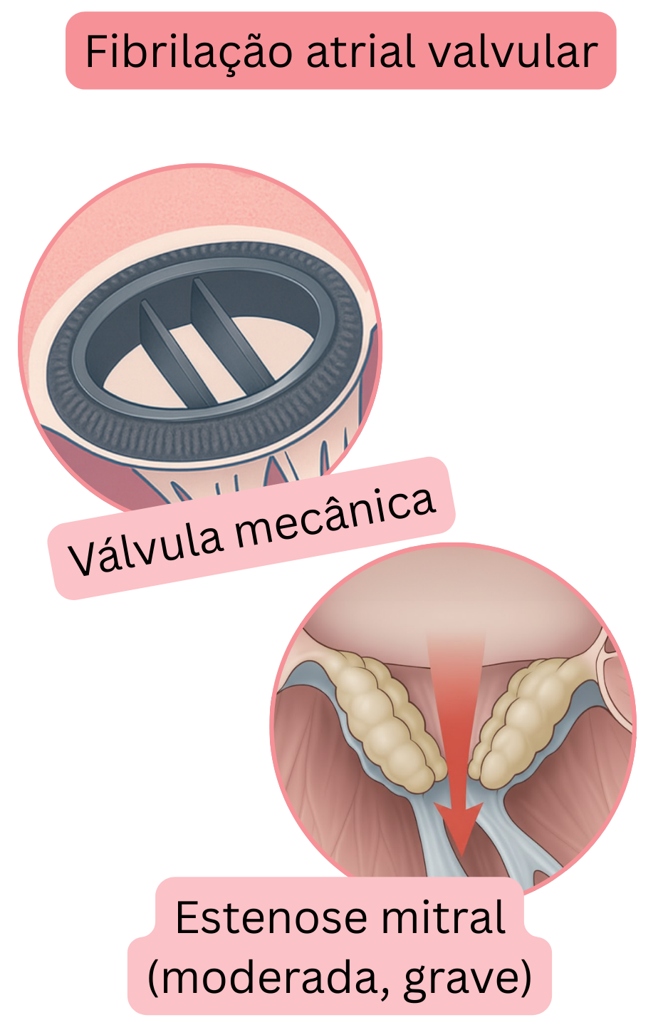 Ilustração da fibrilação atrial valvar na presença de válvula mecânica e estenose mitral moderada a grave.